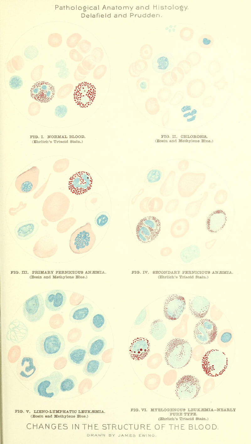 Pathological Anatomy and Histology. Delafield and Prudden. *»•«♦ FIG. I. NOHMAL BLOOD, (Ehrlieli's Triacid Stain.) FIG. n. CHLOROSIS. (Eosin and Methylene Blue.) PIG-, in. PKIMAKY PEBNICIOUS ANiEMIA. (Hosm and Methylene Blue.) MG. IV. SECONDARY' PERNICIOUS AlSr.SJMIA. (Ehrlieli's Triacid Stain.) 5 /* c 0 WW PIG. V. lilBNO-LYMPHATIC LEUK.fflMIA. (Eosin and Methylene Blue.) PIG. VI. MTBLOGENOFS LEITKJSMIA-KSARLY PURE TYPE. (Ehrlich's Triacid Stain.) CHANGES IN THE STRUCTURE OF THE BLOOD. DRAWN BY JAMES EWING