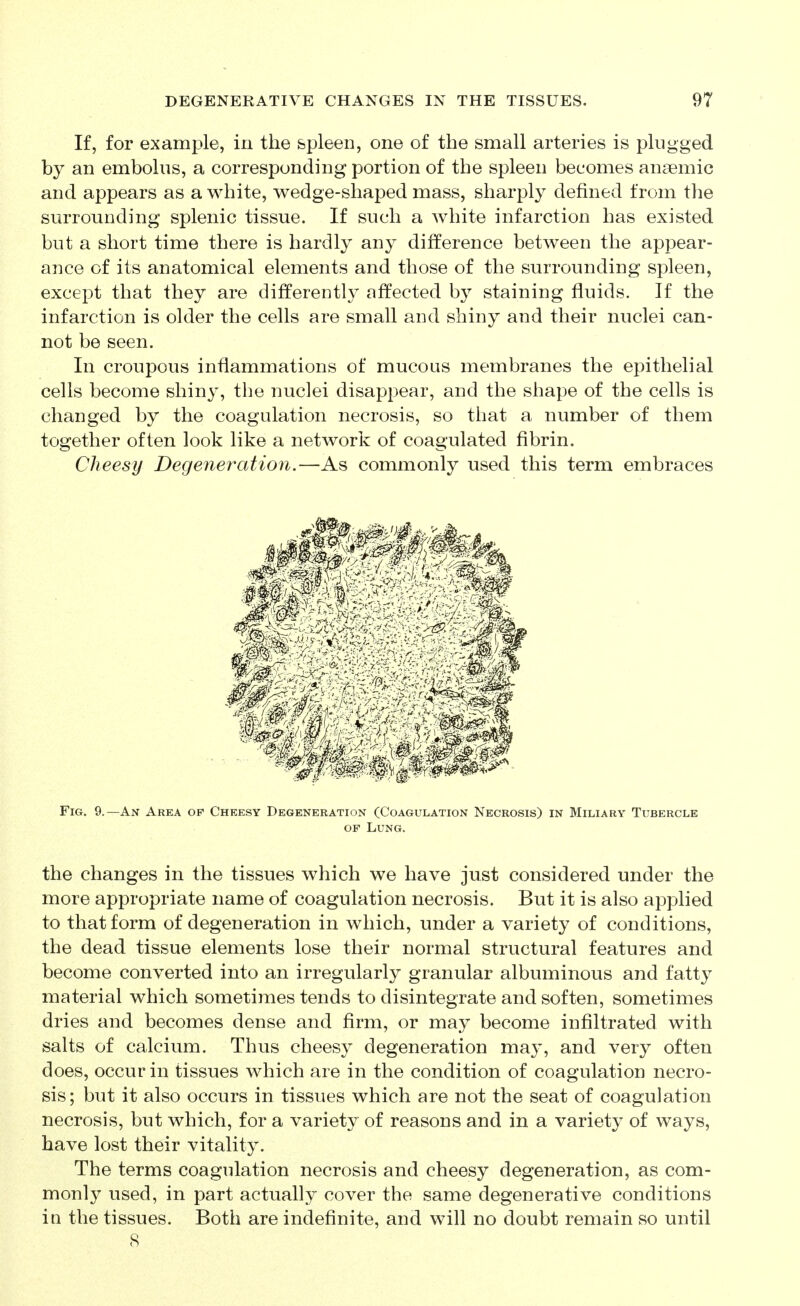 If, for example, in the spleen, one of the small arteries is plugged by an embolus, a corresponding portion of the spleen becomes anaemic and appears as a white, wedge-shaped mass, sharply defined from the surroundhig splenic tissue. If such a white infarction has existed but a short time there is hardly any difference between the appear- ance of its anatomical elements and those of the surrounding spleen, except that they are differently affected b}^ staining fluids. If the infarction is older the cells are small and shiny and their nuclei can- not be seen. In croupous inflammations of mucous membranes the epithelial cells become shiny, the nuclei disappear, and the shape of the cells is changed by the coagulation necrosis, so that a number of them together often look like a network of coagulated fibrin. Cheesy Degeneration.—As commonly used this term embraces the changes in the tissues which we have just considered under the more appropriate name of coagulation necrosis. But it is also applied to that form of degeneration in which, under a variety of conditions, the dead tissue elements lose their normal structural features and become converted into an irregularly granular albuminous and fatty material which sometimes tends to disintegrate and soften, sometimes dries and becomes dense and firm, or may become infiltrated with salts of calcium. Thus cheesy degeneration may, and very often does, occur in tissues which are in the condition of coagulation necro- sis; but it also occurs in tissues which are not the seat of coagulation necrosis, but which, for a variety of reasons and in a variety of ways, have lost their vitality. The terms coagulation necrosis and cheesy degeneration, as com- monly used, in part actually cover the same degenerative conditions in the tissues. Both are indefinite, and will no doubt remain so until Fig. 9.—An Area of Cheesy Degeneration (Coagulation Necrosis) in Miliary Tubercle OF Lung. 8