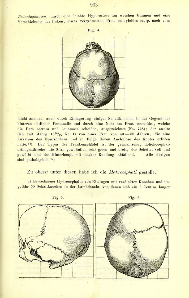 Brünninghausen, durch eine leichte Hyperostose am weichen Gaumen und eine Verschiebung des linken, etwas vergrösserten Proc. condyloides occip. nach vorn Fig. 4. leicht anomal, auch durch Einlagerung einiger Schaltknochen in der Gegend der hinteren seitlichen Fontanelle und durch eine Naht am Proc. mastoides, welche die Pars petrosa und squamosa scheidet, ausgezeichnet (No. 728); der zweite (No. 749. Jahrg. 183V35 No. 1) von einer Frau von 40 — 50 Jahren, die eine Luxation des Epistropheus und in Folge davon Anchylose des Kopfes erlitten hatte.n) Der Typus der Frankenschädel ist der germanische, dolichocephal- orthognathische, die Stirn gewöhnlich sehr gross und breit, der Scheitel voll und gewölbt und das Hinterhaupt mit starker Rundung abfallend. — Alle übrigen sind pathologisch.12) Zu oberst unter diesen habe ich die Makrocephali gestellt: 3) Erwachsener Hydrocephalus von Kitzingen mit verdickten Knochen und un- gefähr 50 Schaltknochen in der Lambdanaht, von denen sich ein 6 Centim. langer