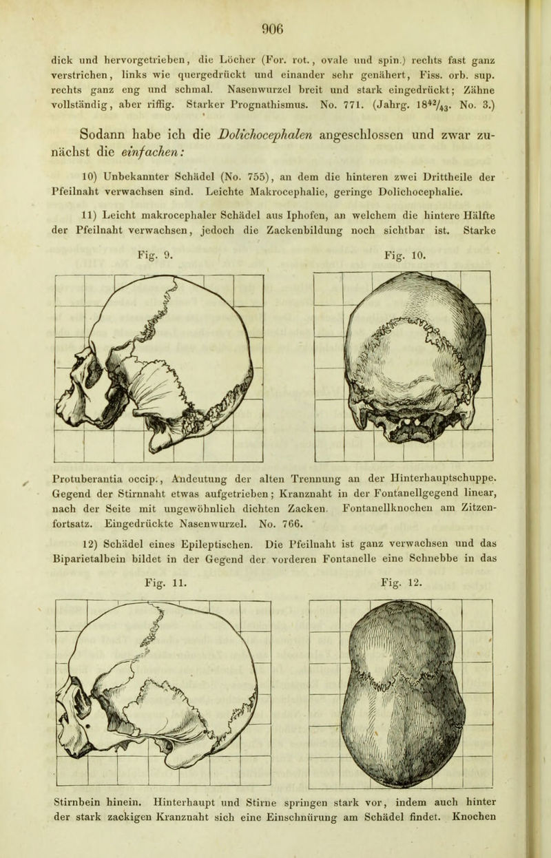 dick und hervorgetrieben, die Löcher (For. rot., ovale und spin.) rechts fast ganz verstrichen, links wie quergedriiekt und einander sehr genähert, Fiss. orb. sup. rechts ganz eng und schmal. Nasenwurzel breit und stark eingedrückt; Zähne vollständig, aber riffig. Starker Prognathismus. No. 771. (Jahrg. 18*2/»3- No. 3.) Sodann habe ich die Dolichocephalen angeschlossen und zwar zu- nächst die einfachen: 10) Unbekannter Schädel (No. 755), an dem die hinteren zwei Drittheile der Pfeilnaht verwachsen sind. Leichte Makrocephalic, geringe Dolichoceplialie. 11) Leicht makroccphaler Schädel aus Iphofen, an welchem die hintere Hälfte der Pfcilnaht verwachsen, jedoch die Zackenbildung noch sichtbar ist. Starke Fig. 9. Fig. 10. Protuberantia oeeip., Andeutung der alten Trennung an der Hinterhauptschuppe. Gegend der Stirnnaht etwas aufgetrieben; Kranznaht in der Fontanellgegend linear, nach der Seite mit ungewöhnlich dichten Zacken. Fontanellknochen am Zitzen- fortsatz. Eingedrückte Nasenwurzel. No. 766. 12) Schädel eines Epileptischen. Die Pfeilnaht ist ganz verwachsen und das Biparietalbein bildet in der Gegend der vorderen Fontanelle eine Schnebbe in das Fig. 11. Fig. 12. Stirnbein hinein. Hinterhaupt und Stirne springen stark vor, indem auch hinter der stark zackigen Kranznaht sich eine Einschnürung am Schädel findet. Knochen