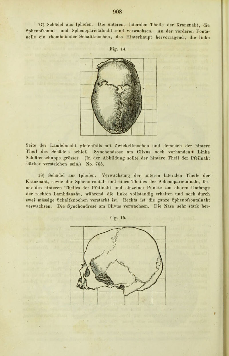 008 17) Schädel aus Iphofen. Die unteren, lateralen Theile der KranzTiaht, die Sphenofrontal • und Sphenoparietalnaht sind verwachsen. An der vorderen Fonta- nelle ein rhomboidaler Schaltknochen, das Hinterhaupt hervorragend, die linke Fig. 14. Seite der Lambdanaht gleichfalls mit Zwickelknochen und demnach der hintere Theil des Schädels schief. Synchondrose am Clivus noch vorhanden.« Linke Schläfenschuppe grösser. (In der Abbildung sollte der hintere Theil der Pfeilnaht stärker verstrichen sein.) No. 765. 18) Schädel aus Iphofen. Verwachsung der unteren lateralen Theile der Kranznaht, sowie der Sphenofrontal- und eines Theiles der Sphenoparietalnaht, fer- ner des hinteren Theiles der Pfeilnaht und einzelner Punkte am oberen Umfange der rechten Lambdanaht, während die linke vollständig erhalten und noch durch zwei mässige Schaltknochen verstärkt ist. Rechts ist die ganze Sphenofrontalnaht verwachsen. Die Synchondrose am Clivus verwachsen. Die Nase sehr stark her-