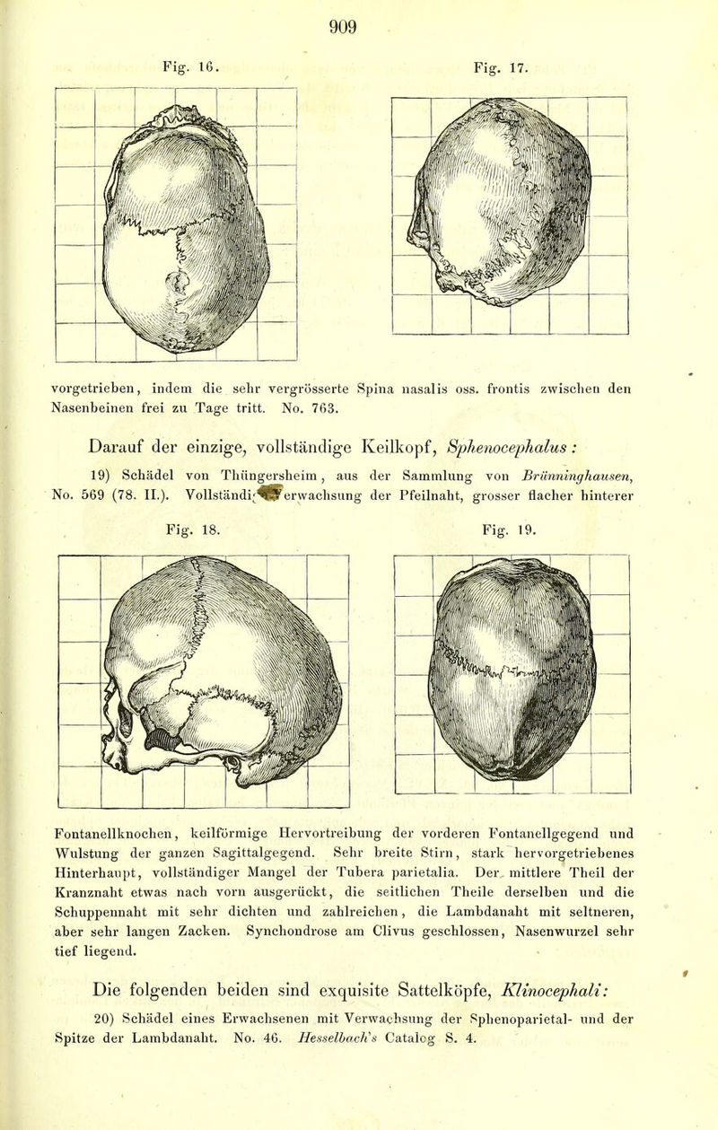 Fig. 16. Fig. 17. vorgetrieben, indem die sehr vergrösserte Spina nasalis oss. frontis zwischen den Nasenbeinen frei zu Tage tritt. No. 763. Darauf der einzige, vollständige Keilkopf, Sphenocephalus : 19) Schädel von Thüngersheim, aus der Sammlung von Brünninghausen, No. 569 (78. IL). Vollständi^^erwachsung der Pfeilnaht, grosser flacher hinterer Fig. 18. Fig. 19. Fontanellknochen, keilförmige Hervortreibung der vorderen Fontanellgegend und Wulstung der ganzen Sagittalgegend. Sehr breite Stirn, stark hervorgetriebenes Hinterhaupt, vollständiger Mangel der Tubera parietalia. Der mittlere Theil der Kranznaht etwas nach vorn ausgerückt, die seitlichen Theile derselben und die Schuppennaht mit sehr dichten und zahlreichen, die Lambdanaht mit seltneren, aber sehr langen Zacken. Synchoudrose am Clivus geschlossen, Nasenwurzel sehr tief liegend. Die folgenden beiden sind exquisite Sattelköpfe, Klinocephali: 20) Schädel eines Erwachsenen mit Verwachsung der Sphenoparietal- und der Spitze der Lambdanaht. No. 46. Hesselbachs Catalcg S. 4.