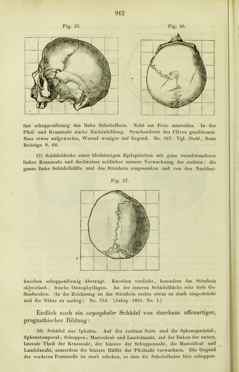 Fig. 25. Fig. 26. fast schuppenformig das linke Scheitelbein. Naht ain Proc. mastoides. In der Pfeil- und Kranznaht starke Zackenhildung. Synchondrose des Clivus geschlossen Nase etwas aufgeworfen, Wurzel weniger tief liegend. No. 767. Vgl. Stahl, Neue Beiträge S. 68. 27) Schädeldecke eines blödsinnigen Epileptischen mit ganz verschwundener linker Kranznaht und theilweiser seitlicher unterer Verwachsung der rechten ; die ganze linke Schädelhälfte und das Stirnbein eingesunken und von den Nachbar- Fig. 27. knochen schuppenförmig überragt. Knochen verdickt, besonders das Stirnbein sklerotisch ; frische Osteophytlagen. An der inneren Schädelfläche sehr tiefe Ge- fässfurchen. (In der Zeichnung ist das Stirnbein rechts etwas zu stark eingedrückt und die Nähte zu zackig.) No. 753. (Jahrg. 1851. No. 1.) Endlich noch ein oxycephaler Schädel von durchaus affenartiger, prognathischer Bildung: 28) Schädel aus Iphofen. Auf der rechten Seite sind die Sphenoparietal-, Sphenotemporal-, Schuppen-, Mastoideal- und Lambdanaht, auf der linken der untere, laterale Theil der Kranznaht, der hintere der Schuppennaht, die Mastoideal- und Lambdanaht, ausserdem die hintere Hälfte der Pfeilnaht verwachsen. Die Gegend der vorderen Fontanelle ist stark erhoben, so dass die Scheitelbeine hier schuppen-