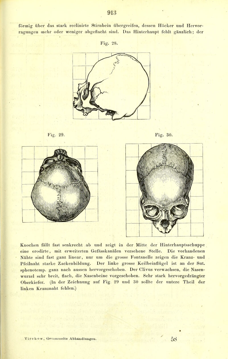 förmig über das stark reclinirte Stirnbein übergreifen, dessen Hücker und Hervor- ragungen mehr oder weniger abgeflacht sind. Das Hinterhaupt fehlt gänzlich; der Fiff. 28. Fig. 29. Fig. 30. Knochen fällt fast senkrecht ab und zeigt in der Mitte der Hinterhauptsschuppe eine erodirte, mit erweiterten Gefässkanälen versehene Stelle. Die vorhandenen Nähte sind fast ganz linear, nur um die grosse Fontanelle zeigen die Kranz- und Pfeilnaht starke Zackenbildung. Der linke grosse Keilbeinflügel ist an der Sut. sphenotemp. ganz nach aussen hervorgeschoben. Der Clivus verwachsen, die Nasen- wurzel sehr breit, flach, die Nasenbeine vorgeschoben. Sehr stark hervorgedrängter Oberkiefer. (In der Zeichnung auf Fig. 29 und 30 sollte der untere Theil der linken Kranznaht fehlen:) Virchow, Gesammelte Abhandlungen.