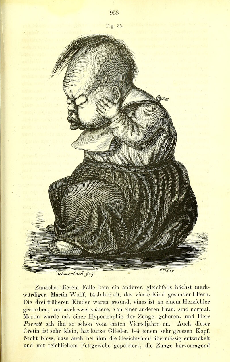 Fig. 35. Zunächst diesem Falle kam ein anderer, gleichfalls höchst merk- würdiger, Martin Wolff, 14 Jahre alt, das vierte Kind gesunder Eltern. Die drei früheren Kinder waren gesund, eines ist an einem Herzfehler gestorben, und auch zwei spätere, von einer anderen Frau, sind normal. Martin wurde mit einer Hypertrophie der Zunge geboren, und Herr Parrott sah ihn so schon vom ersten Vierteljahre an. Auch dieser Cretin ist sehr klein, hat kurze Glieder, bei einem sehr grossen Kopf. Nicht bloss, dass auch bei ihm die Gesichtshaut übermässig entwickelt und mit reichlichem Fettgewebe gepolstert, die Zunge hervorragend