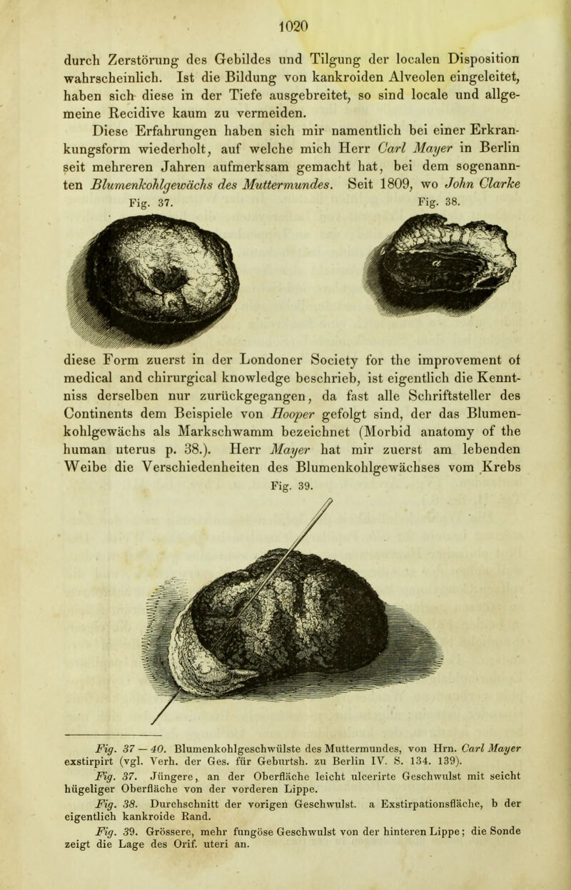 durch Zerstörung des Gebildes und Tilgung der localen Disposition wahrscheinlich. Ist die Bildung von kankroiden Alveolen eingeleitet, haben sich diese in der Tiefe ausgebreitet, so sind locale und allge- meine Recidive kaum zu vermeiden. Diese Erfahrungen haben sich mir namentlich bei einer Erkran- kungsform wiederholt, auf welche mich Herr Carl Mayer in Berlin seit mehreren Jahren aufmerksam gemacht hat, bei dem sogenann- ten Blumenkohlgewächs des Muttermundes. Seit 1809, wo John ClarJce Fig. 37. Fig. 38. diese Form zuerst in der Londoner Society for the improvement ot medical and chirurgical knowledge beschrieb, ist eigentlich die Kennt- niss derselben nur zurückgegangen, da fast alle Schriftsteller des Continents dem Beispiele von Hooper gefolgt sind, der das Blumen- kohlgewächs als Markschwamm bezeichnet (Morbid anatomy of the human uterus p. 38.). Herr Mayer hat mir zuerst am lebenden Weibe die Verschiedenheiten des Blumenkohlgewächses vom Krebs Fig. 39. Fig. 37 — 40. Blumenkohlgeschwülste des Muttermundes, von Hrn. Carl Mayer exstirpirt (vgl. Verh. der Ges. für Geburtsh. zu Berlin IV. S. 134. 139). Fig. 37. Jüngere, an der Oberfläche leicht ulcerirte Geschwulst mit seicht hügeliger Oberfläche von der vorderen Lippe. Fig. 38. Durchschnitt der vorigen Geschwulst, a Exstirpationsfläche, b der eigentlich kankroide Rand. Fig. 39. Grössere, mehr fungöse Geschwulst von der hinteren Lippe ; die Sonde zeigt die Lage des Orif. uteri an.