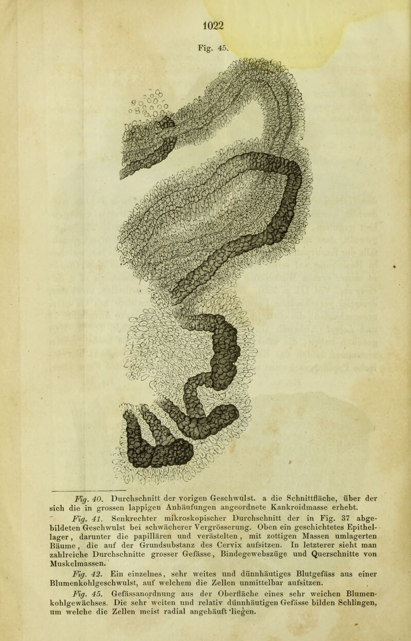 Fig. 40. Durchschnitt der vorigen Geschwulst, a die Schnittfläche, üher der sich die in grossen lappigen Anhäufungen angeordnete Kankroidmasse erhebt. Fig. 41. Senkrechter mikroskopischer Durchschnitt der in Fig. 37 abge- bildeten Geschwulst bei schwächerer Vergrösserung. Oben ein geschichtetes Epithel- lager , darunter die papillären und verästelten , mit zottigen Massen umlagerten Bäume, die auf der Grundsubstanz des Cervix aufsitzen. In letzterer sieht man zahlreiche Durchschnitte grosser Gefässe, Bindegewebszüge und Querschnitte von Muskelmassen. Fig. 42. Ein einzelnes, sehr weites und dünnhäutiges Blutgefäss aus einer Blumenkohlgeschwulst, auf welchem die Zellen unmittelbar aufsitzen. Fig. 45. GefässanOrdnung aus der Oberfläche eines sehr weichen Blumen- kohlgewächses. Die sehr weiten und relativ dünnhäutigen Gefässe bilden Schlingen, um welche die Zellen meist radial angehäuft liegen.