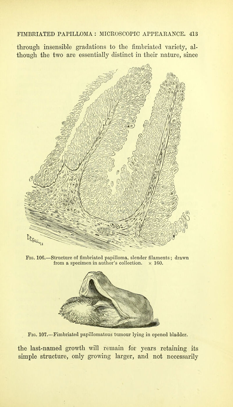 through insensible gradations to the fimbriated variety, al- though the two are essentially distinct in their nature, since Fig. 106.—Structure of fimbriated papilloma, slender filaments; drawn from a specimen in author's collection, x 160. Fig. 107.—Fimbriated papillomatous tumour lying in opened bladder. the last-named growth will remain for years retaining its simple structure, only growing larger, and not necessarily