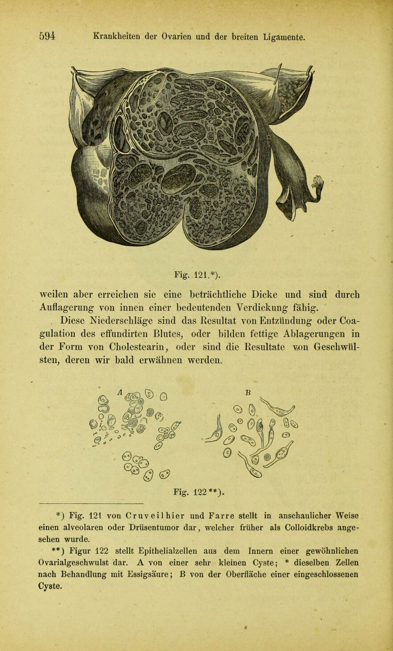 Fig. 121.*). weilen aber erreichen sie eine beträchtliche Dicke und sind durch Auflagerung von innen einer bedeutenden Verdickung fähig. Diese Niederschläge sind das Resultat von Entzündung oder Coa- gulation des effundirten Blutes, oder bilden fettige Ablagerungen in der Form von Cholestearin, oder sind die Resultate von Geschwül- sten, deren wir bald erwähnen werden. Fig. 122**). *) Fig. 121 von Cruveil hier und Farre stellt in anschaulicher Weise einen alveolaren oder Drüsentumor dar, welcher früher als Colloidkrebs ange- sehen wurde. **) Figur 122 stellt Epithelialzellen aus dem Innern einer gewöhnlichen Ovarialgeschwulst dar. A von einer sehr kleinen Cyste; * dieselben Zellen nach Behandlung mit Essigsäure; ß von der Oberfläche einer eingeschlossenen Cyste. >