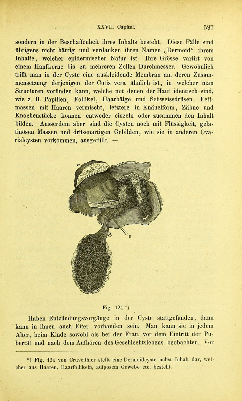 sondern in der Beschaffenheit ihres Inhalts besteht. Diese Fälle sind übrigens nicht häufig und verdanken ihren Namen „Dermoid ihrem Inhalte, welcher epidermischer Natur ist. Ihre Grösse variirt von einem Hanfkorne bis zu mehreren Zollen Durchmesser. Gewöhnlich trifft man in der Cyste eine auskleidende Membran an, deren Zusam- mensetzung derjenigen der Cutis vera ähnlich ist, in welcher man Structuren vorfinden kann, welche mit denen der Haut identisch sind, wie z. B. Papillen, Follikel, Haarbälge und Schweissdrüsen. Fett- massen mit Haaren vermischt, letztere in Knäuelform, Zähne und Knochenstücke können entweder einzeln oder zusammen den Inhalt bilden. Ausserdem aber sind die Cysten noch mit Flüssigkeit, gela- tinösen Massen und drüsenartigen Gebilden, wie sie in anderen Ova- rialcysten vorkommen, ausgefüllt. — Fig. 124 *). Haben Entzündungsvorgänge in der Cyste stattgefunden, dann kann in ihnen auch Eiter vorhanden sein. Man kann sie in jedem Alter, beim Kinde sowohl als bei der Frau, vor dem Eintritt der Pu- bertät und nach dem Aufhören des Geschlechtslebens beobachten. Vor *) Fig. 124 von Cruveilhier stellt eine Dermoidcyste nebst Inhalt dar, wel- cher aus Haaren, Haarfollikeln, adiposem Gewebe etc. besteht.