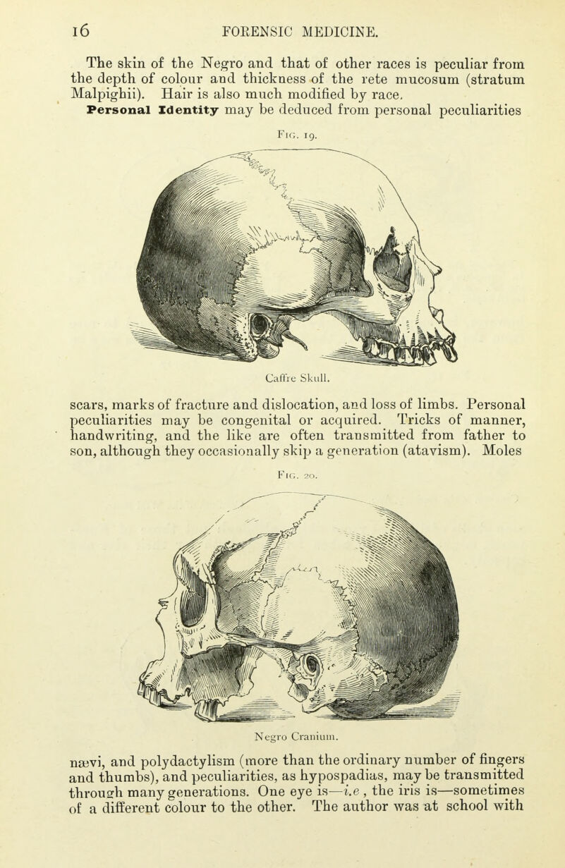 The skin of the Negro and that of other races is peculiar from the depth of colour and thickness of the rete mucosum (stratum Malpighii). Hair is also much modified by race. Personal Identity may be deduced from personal peculiarities Fig. 19. Caffre Skull. scars, marks of fracture and dislocation, and loss of limbs. Personal peculiarities may be congenital or acquired. Tricks of manner, handwriting, and the like are often transmitted from father to son, although they occasionally skip a generation (atavism). Moles Fig. 20. Negro Cranium. najvi, and polydactylism (more than the ordinary number of fingers and thumbs), and peculiarities, as hypospadias, may be transmitted throusrh many generations. One eye is—i.e , the iris is—sometimes of a different colour to the other. The author was at school with