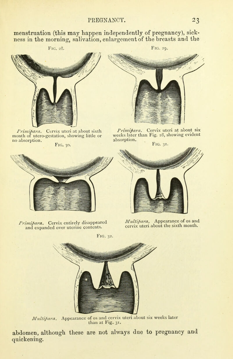 menstruation (this may happen independently of pregnancy), sick- ness in the morning, salivation, enlargement of the breasts and the Fig. 28. Fig. 29. Frimipara. Cervix uteri at about sixth Primipara. Cervix uteri at about six month of utero-gestation, showing little or weeks later than Fig. 28, showing evident no absorption. absorption. Fig. 30. Fig. 31. Frimipara. Cervix entirely disappeared Multipara. Appearance of os and and expanded over uterine contents. cervix uteri about the sixth month. Fig. 32. Multipara. Appearance of os and cervix uteri about six weeks later than at Fig. 31. abdomen, although these are not always due to pregnancy and quickening.