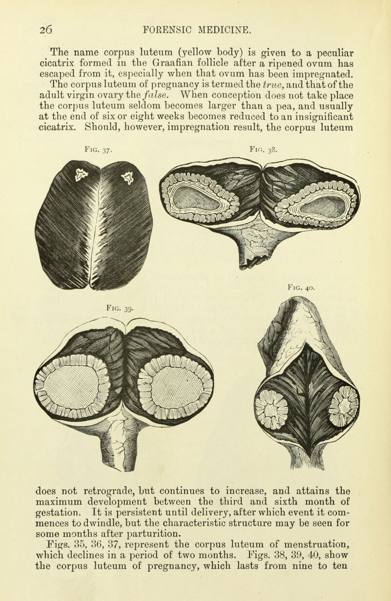 The name corpus luteum (yellow body) is given to a peculiar cicatrix formed in the Graafian follicle after a ripened ovum has escaped from it, especially when that ovum has been impregnated. The corpus luteum of pregnancy is termed the true, and that of the adult virgin ovary the false. When conception does not take place the corpus luteum seldom becomes larger than a pea, and usually at the end of six or eight weeks becomes reduced to an insignificant cicatrix. Should, however, impregnation result, the corpus luteum Fig. 37. Fir;. 38. does not retrograde, but continues to increase, and attains the maximum development between the third and sixth month of gestation. It is persistent until delivery, after which event it com- mences to dwindle, but the characteristic structure may be seen for some months after parturition. Figs. 35, 36, 37, represent the corpus luteum of menstruation, which declines in a period of two months. Figs. 38, 39, 40, show the corpus luteum of pregnancy, which lasts from nine to ten