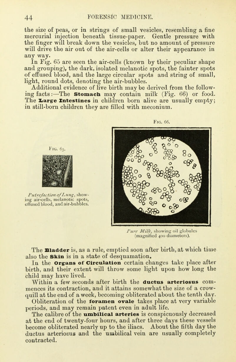 the size of peas, or in strings of small vesicles, resembling a fine mercurial injection beneath tissue-paper. Gentle pressure with the finger will break down the vesicles, but no amount of pressure will drive the air out of the air-cells or alter their appearance in any way. In Fig. 65 are seen the air-cells (known by their peculiar shape and grouping), the dark, isolated melanotic spots, the fainter spots of effused blood, and the large circular spots and string of small, light, round dots, deuoting the air-bubbles. Additional evidence of live birth may be derived from the follow- ing facts:—The Stomach may contain milk (Fig. 66) or food. The Iiargre Intestines in children born alive are usually empty; in still-born children they are filled with meconium. The Bladder is, as a rule, emptied soon after birth, at which time also the Skin is in a state of desquamation. In the Organs of Circulation certain changes take place after birth, and their extent will throw some light upon how long the child may have lived. Within a few seconds after birth the ductus arteriosus com- mences its contraction, and it attains somewhat the size of a crow- quill at the end of a week, becoming obliterated about the tenth day. Obliteration of the foramen ovale takes place at very variable periods, and may remain patent even in adult life. The calibre of the umbilical arteries is conspicuously decreased at the end of twenty-four hours, and after three days these vessels become obliterated nearly up to the iliacs. About the fifth, day the ductus arteriosus and the umbilical vein are usually completely contracted. Fig. 66. P Hire/action of Lung, show- ing air-cells, melanotic spots, effused blood, and air-bubbles. Pure Milk, showing oil globules (magnified 400 diameters).
