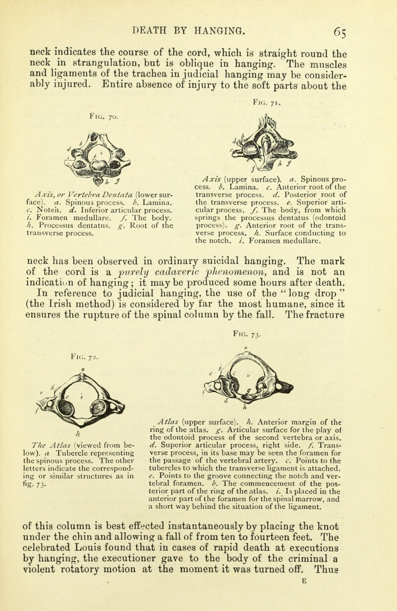 neck indicates the course of the cord, which is straight round the neck in strangulation, but is oblique in hanging. The muscles and ligaments of the trachea in judicial hanging may be consider- ably injured. Entire absence of injury to the soft parts about the Fig. 71. Fig. 70. Axis, or Vertebra Dentata (lower sur- face), a. Spinous process. Lamina. c. Noteh. d. Inferior articular process. i. Foramen medullare. f. The body. h. Processus dentatus. g. Root of the transverse process. Axis (upper surface), a. Spinous pro- cess, b. Lamina, c. Anterior root of the transverse process, d. Posterior root of the transverse process, e. Superior arti- cular process, f. The body, from which springs the processus dentatus (odontoid process), g. Anterior root of the trans- verse process, ft. Surface conducting to the notch, i. Foramen medullare. neck has been observed in ordinary suicidal hanging. The mark of the cord is a purely cadaveric phenomenon, and is not an indication of hanging; it maybe produced some hours after death. In reference to judicial hanging, the use of the long drop (the Irish method) is considered by far the most humane, since it ensures the rupture of the spinal column by the fall. The fracture Fig. 73. Fig. 72. The Atlas (viewed from be- low), a Tubercle representing the spinous process. The other letters indicate the correspond- ing or similar structures as in %• 73- Atlas (upper surface), h. Anterior margin of the ring of the atlas, g. Articular surface for the play of the odontoid process of the second vertebra or axis. d. Superior articular process, rie;ht side. f. Trans- verse process, in its base may be seen the foramen for the passage of the vertebral artery, c. Points to the tubercles to which the transverse ligament is attached. e. Points to the groove connecting the notch and ver- tebral foramen. b. The commencement of the pos- terior part of the ring of the atlas, i. Is placed in the anterior part of the foramen for the spinal marrow, and a short way behind the situation of the ligament. of this column is best effected instantaneously by placing the knot under the chin and allowing a fall of from ten to fourteen feet. The celebrated Louis found that in cases of rapid death at executions by hanging, the executioner gave to the body of the criminal a violent rotatory motion at the moment it was turned off. Thus E