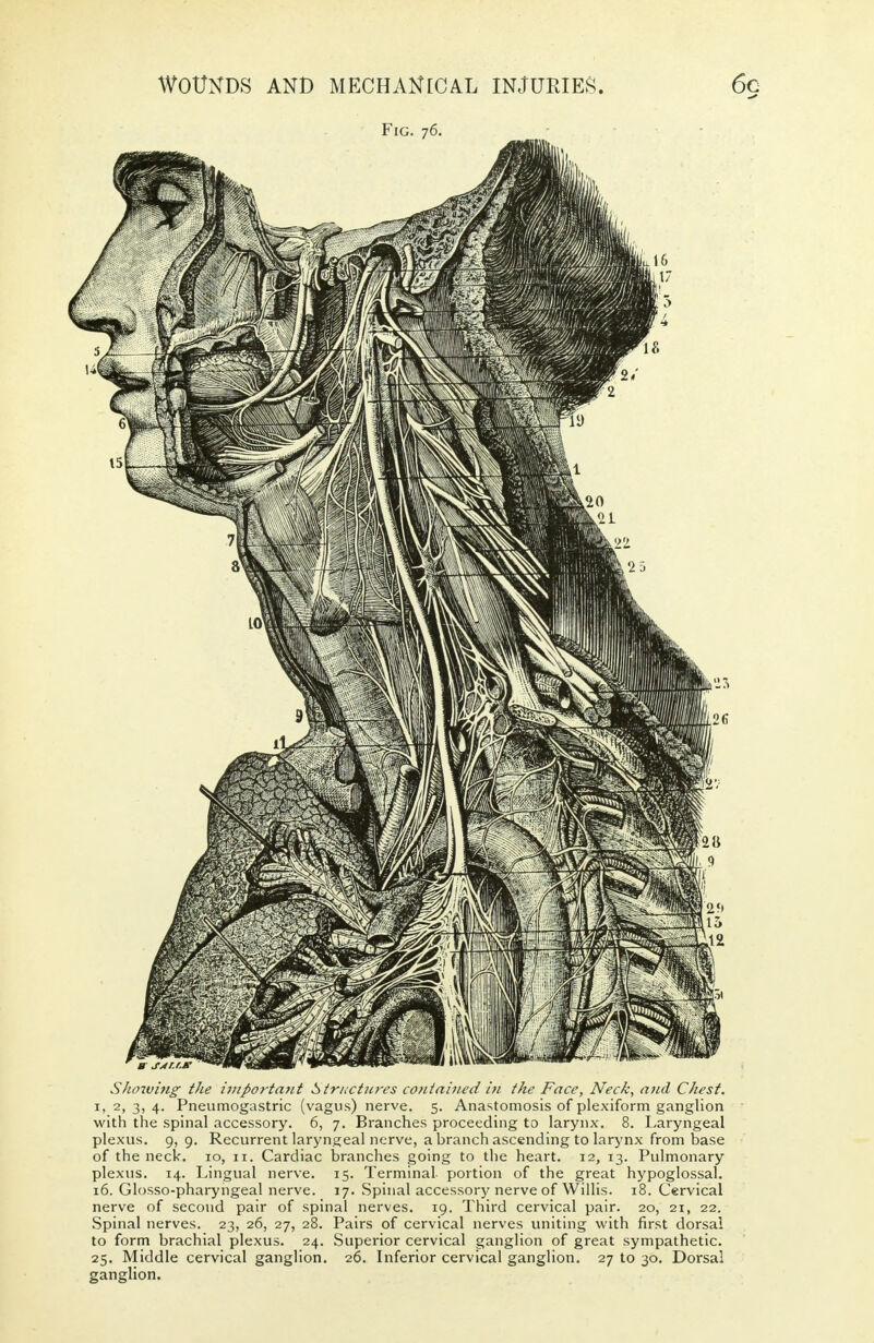 Fig. 76. Showing the important structures contained in the Face, Neck, and Chest. 1, 2, 3, 4. Pneumogastric (vagus) nerve. 5. Anastomosis of plexiform ganglion with the spinal accessory. 6, 7. Branches proceeding to larynx. 8. Laryngeal plexus. 9, 9. Recurrent laryngeal nerve, a branch ascending to larynx from base of the neck. 10, 11. Cardiac branches going to the heart. 12, 13. Pulmonary plexus. 14. Lingual nerve. 15. Terminal portion of the great hypoglossal. 16. Glosso-pharyngeal nerve. 17. Spinal accessory nerve of Willis. 18. Cervical nerve of second pair of spinal nerves. 19. Third cervical pair. 20, 21, 22. Spinal nerves. 23, 26, 27, 28. Pairs of cervical nerves uniting with first dorsal to form brachial plexus. 24. Superior cervical ganglion of great sympathetic. 25. Middle cervical ganglion. 26. Inferior cervical ganglion. 27 to 30. Dorsal ganglion.