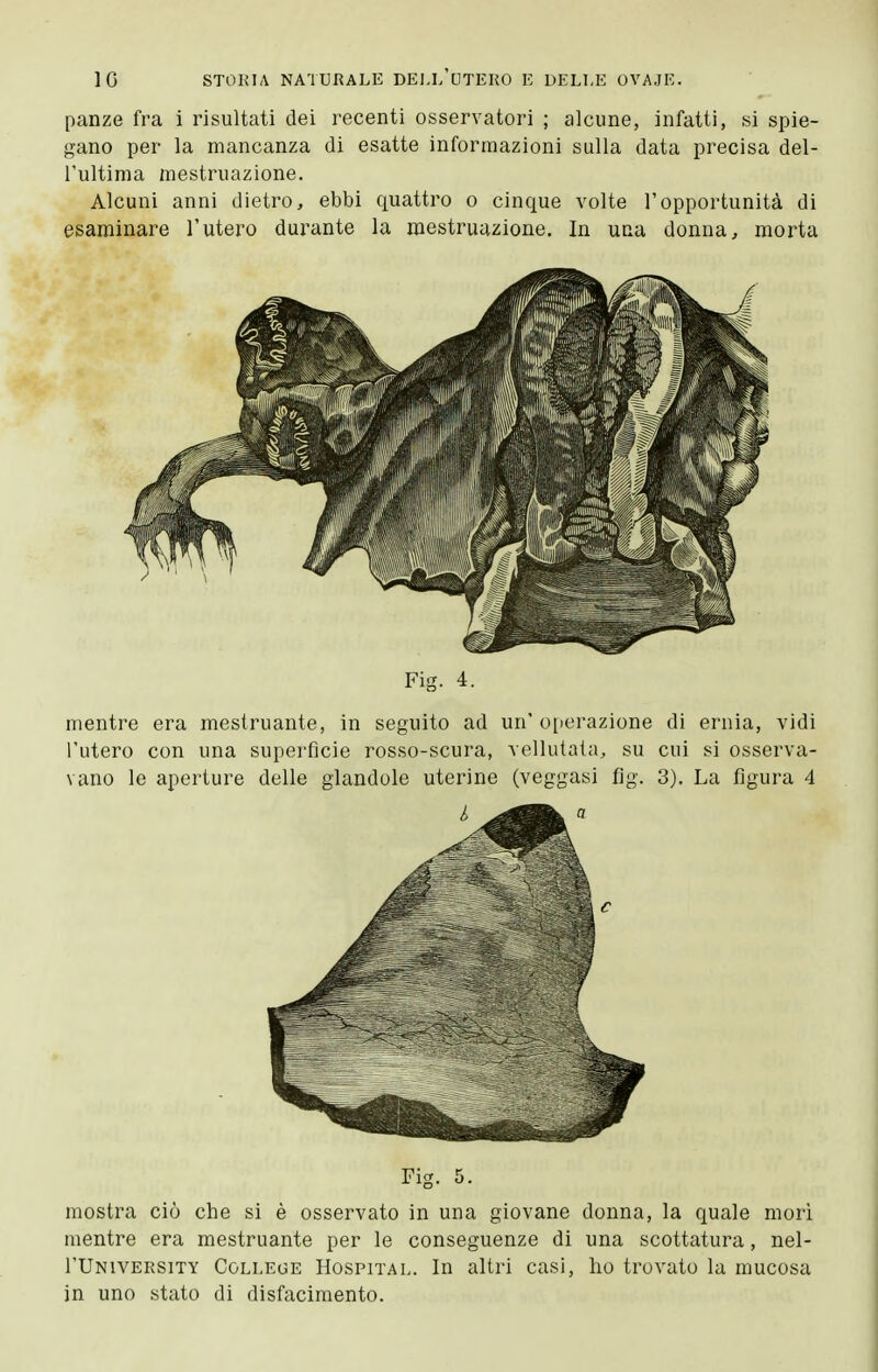 panze fra i risultati dei recenti osservatori ; alcune, infatti, si spie- gano per la mancanza di esatte informazioni sulla data precisa del- l'ultima mestruazione. Alcuni anni dietro, ebbi quattro o cinque volte l'opportunità di esaminare l'utero durante la mestruazione. In una donna, morta Fig. 4. mentre era mestruante, in seguito ad un' operazione di ernia, vidi l'utero con una superfìcie rosso-scura, vellutata, su cui si osserva- vano le aperture delle glandole uterine (veggasi fìg. 3). La figura 4 Fig. 5. mostra ciò che si è osservato in una giovane donna, la quale morì mentre era mestruante per le conseguenze di una scottatura, nel- rUNivERSiTY College Hospital. In altri casi, ho trovato la mucosa in uno stato di disfacimento.