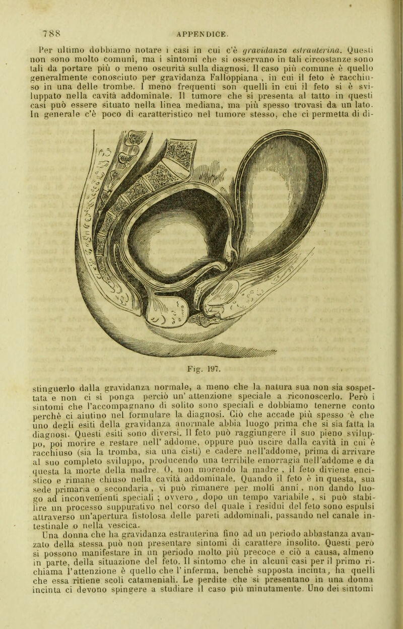 Per ullimo dolibiamo notare i casi in cui c'è gravidanza tHtraalcrina. (juesii non sono molto comuni, ma i sintomi che si osservano in tali circostanze sono tali (la portare più o meno oscurità sulla diagnosi. 11 caso più comune è quello generalmente conosciuto per gravidanza Falloppiana , in cui il feto è racchiu- so in una delle trombe. I meno frequenti son quelli in cui il feto si è svi- luppato nella cavità addominale. Il tumore che si presenta al tatto in questi casi può essere situato nella linea mediana, ma più spesso trovasi da un lato. In generale c'è poco di caratteristico nel tumore stesso, che ci permetta di di- Fig. 197. stinizuerlo dalla gravidanza normale, a meno che la natura sua non sia sospet- tatale non ci si ponga perciò un'attenzione speciale a riconoscerlo. Però i sintomi che l'accompagnano di solito sono speciali e dobbiamo^ tenerne conto pei'chè ci aiutino nel formulare la diagnosi. Ciò che accade più spesso è che uno degli esiti della gravidanza anormale abbia luogo prima che si sia fatta la diagnosi. Questi esiti sono diversi. 11 feto può raggiungere il suo pieno svilup- po,°poi morire e restare uell' addome, oppure può uscire dalla cavità in cui è racchiuso (sia la tromba, sia una cisti) e cadere nell'addome, prima di arrivare al suo completo sviluppo, producendo una terribile emorragia nell'addome e da ([ucsta la morte della madre. 0, non morendo la madre , il feto diviene enci- stico e rimane chiuso nella cavità addominale. Quando il feto è in questa, sua sede primaria o secondaria, vi può rimanere per molli anni, non dando luo- go ad inconvenienti speciali ; ovvero, do[)0 un tempo variabile, si può stabi- lire un processo su|)purativo nel corso del quale i residui del feto sono espulsi attraverso un'apertura hslolosa delle pareti addominali, passando nel canale in- testinale o nella vescica. Una donna che ha, gravidanza estraulerina lino ad un jieriodo abbastanza avan- zato della stessa può non presentare sintomi di carattere insolito. Questi pero si possono manifestare in un periodo molto più precoce e ciò a causa, almeno in parte, della situazione del feto. Il sintomo che in alcuni casi perii primo ri- chiama l'attenzione è quello che l'inferma, benché supposta incinta, ha quelli che essa ritiene scoli catameniah. Le perdite che si presentano in una donna incinta ci devono spingere a studiare il caso più minutamente. Uno dei sintomi