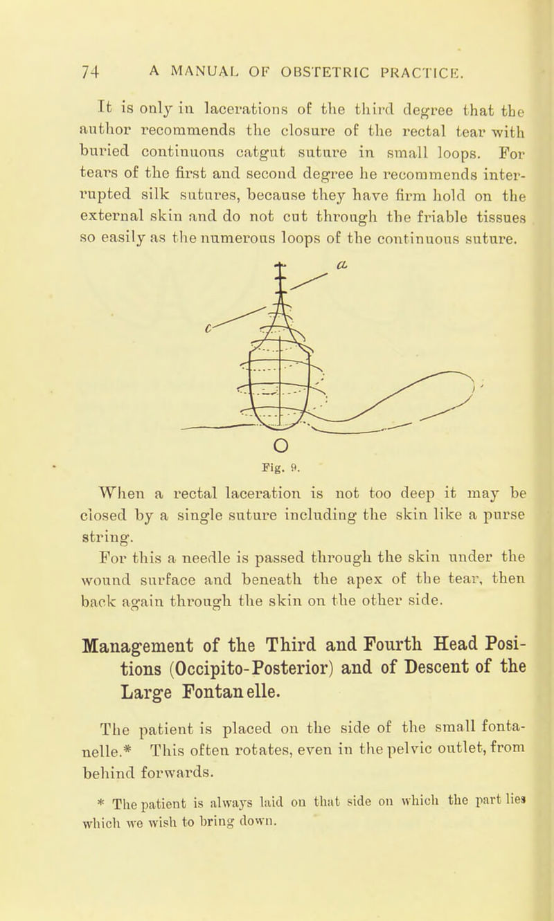 It is only in lacerations of the third degree that the author recommends the closure of the rectal tear with buried continuous catgut suture in small loops. For tears of the first and second degree he recommends inter- rupted silk sutures, because they have firm hold on the external skin and do not cut through the friable tissues so easily as the numerous loops of the continuous suture. o Fig. 9. When a rectal laceration is not too deep it may be closed by a single suture including the skin like a purse string. For this a needle is passed through the skin under the wound surface and beneath the apex of the tear, then back again through the skin on the other side. Management of the Third and Fourth Head Posi- tions (Occipito-Posterior) and of Descent of the Large Fontanelle. The patient is placed on the side of the small fonta- nels* This often rotates, even in the pelvic outlet, from behind forwards. * The patient is always laid on that side on which the part lies which we wish to bring down.
