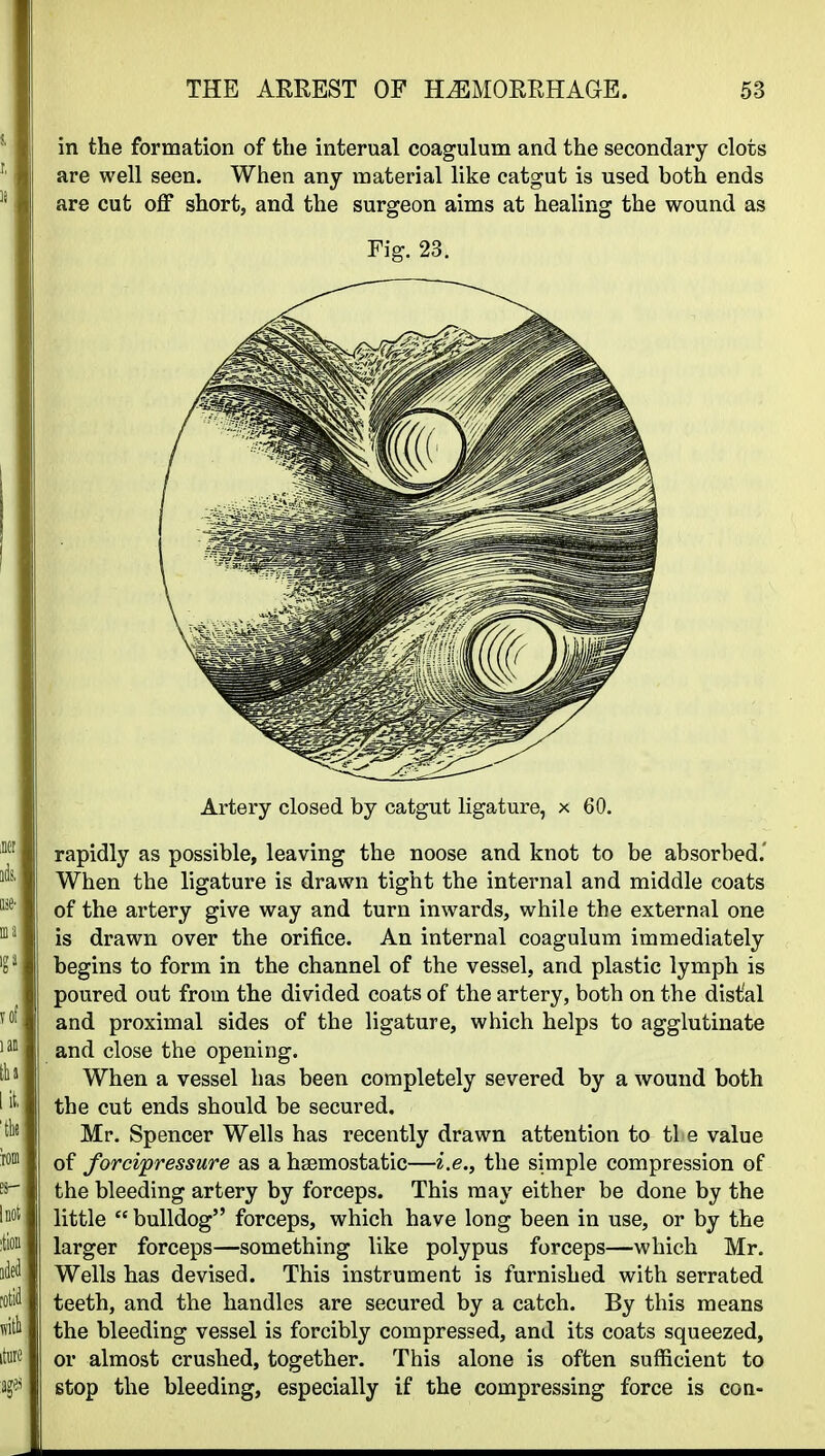 in the formation of the internal coagulum and the secondary clots are well seen. When any material like catgut is used both ends are cut off short, and the surgeon aims at healing the wound as Fig. 23. Artery closed by catgut ligature, x 60. rapidly as possible, leaving the noose and knot to be absorbed.' When the ligature is drawn tight the internal and middle coats of the artery give way and turn inwards, while the external one is drawn over the orifice. An internal coagulum immediately begins to form in the channel of the vessel, and plastic lymph is poured out from the divided coats of the artery, both on the distal and proximal sides of the ligature, which helps to agglutinate and close the opening. When a vessel has been completely severed by a wound both the cut ends should be secured, Mr. Spencer Wells has recently drawn attention to tie value of forcipressure as a haemostatic—i.e., the simple compression of the bleeding artery by forceps. This may either be done by the little  bulldog forceps, which have long been in use, or by the larger forceps—something like polypus forceps—which Mr. Wells has devised. This instrument is furnished with serrated teeth, and the handles are secured by a catch. By this means the bleeding vessel is forcibly compressed, and its coats squeezed, or almost crushed, together. This alone is often sufficient to stop the bleeding, especially if the compressing force is con-