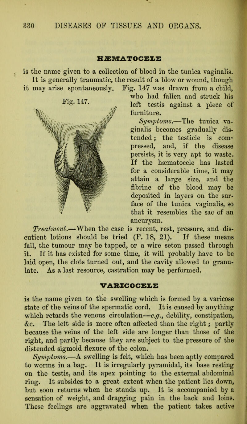 H2:iVIATOCX:i.E is the name given to a collection of blood in the tunica vaginalis. It is generally traumatic, the result of a blow or wound, though it may arise spontaneously. Fig. 147 was drawn from a child, who had fallen and struck his left testis against a piece of furniture. Symptoms.—The tunica va- ginalis becomes gradually dis- tended ; the testicle is com- pressed, and, if the disease persists, it is very apt to waste. If the haematocele has lasted for a considerable time, it may attain a large size, and the fibrine of the blood may be deposited in layers on the sur- face of the tunica vaginalis, so that it resembles the sac of an aneurysm. Treatment.—When the case is recent, rest, pressure, and dis- cutient lotions should be tried (F. 18, 21). If these means fail, the tumour may be tapped, or a wire seton passed through it. If it has existed for some time, it will probably have to be laid open, the clots turned out, and the cavity allowed to granu- late. As a last resource, castration may be performed. VARICOCEI.X: is the name given to the swelling which is formed by a varicose state of the veins of the spermatic cord. It is caused by anything which retards the venous circulation—e.g., debility, constipation, &c. The left side is more often affected than the right; partly because the veins of the left side are longer than those of the right, and partly because they are subject to the pressure of the distended sigmoid flexure of the colon. Symptoms.—A swelling is felt, which has been aptly compared to worms in a bag. It is irregularly pyramidal, its base resting on the testis, and its apex pointing to the external abdominal ring. It subsides to a great extent when the patient lies down, but soon returns when he stands up. It is accompanied by a sensation of weight, and dragging pain in the back and loins. These feelings are aggravated when the patient takes active