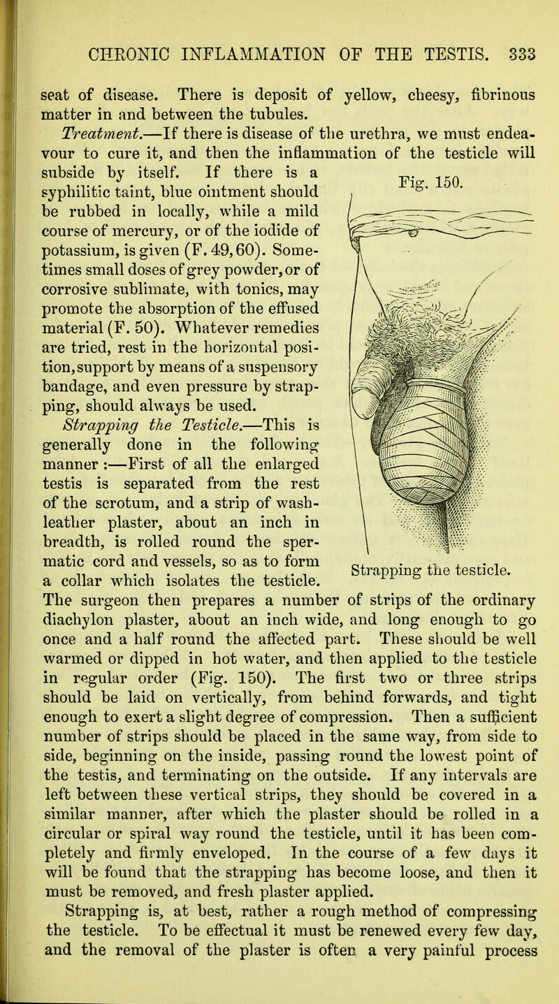 seat of disease. There is deposit of yellow, cheesy, fibrinous matter in and between the tubules. Treatment.—If there is disease of the urethra, we must endea- vour to cure it, and then the inflammation of the testicle will subside by itself. If there is a syphilitic taint, blue ointment should be rubbed in locally, while a mild course of mercury, or of the iodide of potassium, is given (F. 49,60). Some- times small doses of grey powder, or of corrosive sublimate, with tonics, may promote the absorption of the effused material (F. 50). Whatever remedies are tried, rest in the horizontal posi- tion, support by means of a suspensory bandage, and even pressure by strap- ping, should always be used. Strapf ing the Testicle.—This is generally done in the following manner :—First of all the enlarged testis is separated from the rest of the scrotum, and a strip of wash- leather plaster, about an inch in breadth, is rolled round the sper- matic cord and vessels, so as to form a collar which isolates the testicle. The surgeon then prepares a number of strips of the ordinary diachylon plaster, about an inch wide, and long enough to go once and a half round the affected part. These should be well warmed or dipped in hot water, and then applied to the testicle in regular order (Fig. 150). The first two or three strips should be laid on vertically, from behind forwards, and tight enough to exert a slight degree of compression. Then a suf^cient number of strips should be placed in the same way, from side to side, beginning on the inside, passing round the lowest point of the testis, and terminating on the outside. If any intervals are left between these vertical strips, they should be covered in a similar manner, after which the plaster should be rolled in a circular or spiral way round the testicle, until it has been com- pletely and firmly enveloped. In the course of a few days it will be found that the strapping has become loose, and then it must be removed, and fresh plaster applied. Strapping is, at best, rather a rough method of compressing the testicle. To be efiiectual it must be renewed every few day, and the removal of the plaster is often a very painful process Fig. 150. Strapping tiie testicle.