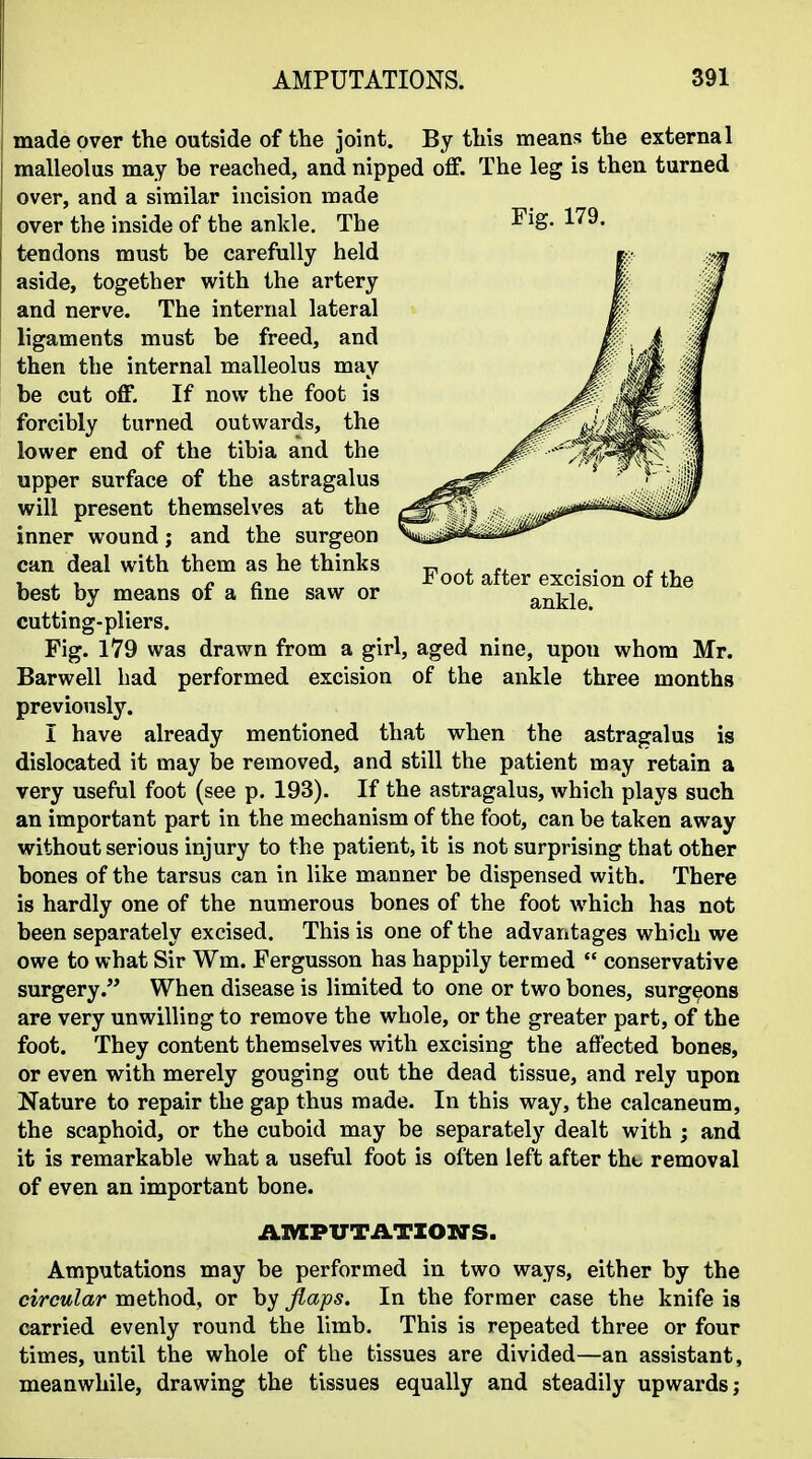 Fig. 179. Foot after excision of the ankle. made over the outside of the joint. By this means the external malleolus may be reached, and nipped off. The leg is then turned over, and a similar incision made over the inside of the ankle. The tendons must be carefully held aside, together with the artery and nerve. The internal lateral ligaments must be freed, and then the internal malleolus may be cut off. If now the foot is forcibly turned outwards, the lower end of the tibia and the upper surface of the astragalus will present themselves at the inner wound; and the surgeon can deal with them as he thinks best by means of a fine saw or cutting-pliers. Fig. 179 was drawn from a girl, aged nine, upon whom Mr. Barwell had performed excision of the ankle three months previously. I have already mentioned that when the astragalus is dislocated it may be removed, and still the patient may retain a very useful foot (see p, 193). If the astragalus, which plays such an important part in the mechanism of the foot, can be taken away without serious injury to the patient, it is not surprising that other bones of the tarsus can in like manner be dispensed with. There is hardly one of the numerous bones of the foot which has not been separately excised. This is one of the advantages which we owe to what Sir Wm. Fergusson has happily termed  conservative surgery. When disease is limited to one or two bones, surgeons are very unwilling to remove the whole, or the greater part, of the foot. They content themselves with excising the affected bones, or even with merely gouging out the dead tissue, and rely upon Nature to repair the gap thus made. In this way, the calcaneum, the scaphoid, or the cuboid may be separately dealt with ; and it is remarkable what a useful foot is often left after tht removal of even an important bone. AMPUTATION'S. Amputations may be performed in two ways, either by the circular method, or by flaps. In the former case the knife is carried evenly round the limb. This is repeated three or four times, until the whole of the tissues are divided—an assistant, meanwhile, drawing the tissues equally and steadily upwards;