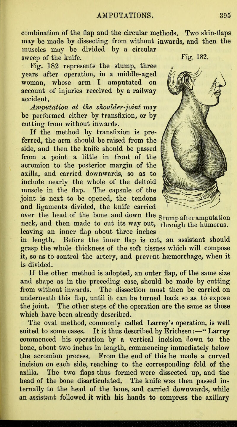 combination of the flap and the circular methods. Two skin-flaps may be made by dissecting from without inwards, and then the muscles may be divided by a circular sweep of the' knife. Fig. 182. Fig. 182 represents the stump, three years after operation, in a middle-aged woman, whose arm I amputated on account of injuries received by a railway accident. Amputation at the shoulder-joint may be performed either by transfixion, or by cutting from without inwards. If the method by transfixion is pre- ferred, the arm should be raised from the side, and then the knife should be passed from a point a little in front of the acromion to the posterior margin of the axilla, and carried downwards, so as to include nearly the whole of the deltoid muscle in the flap. The capsule of the joint is next to be opened, the tendons and ligaments divided, the knife carried over the head of the bone and down the stump after amputation neck, and then made to cut its way out, through the humerus, leaving an inner flap about three inches in length. Before the inner flap is cut, an assistant should grasp the whole thickness of the soft tissues which will compose it, so as to Gontrol the artery, and prevent haemorrhage, when it is divided. If the other method is adopted, an outer flap, of the same size and shape as in the preceding case, should be made by cutting from without inwards. The dissection must then be carried on underneath this fliip, until it can be turned back so as to expose the joint. The other steps of the operation are the same as those which have been already described. The oval method, commonly called Larrey's operation, is well suited to some cases. It is thus described by Erichsen:— Larrey commenced his operation by a vertical incision (own to the bone, about two inches in length, commencing immediately below the acromion process. From the end of this he made a curved incision on each side, reaching to the corresponding fold of the axilla. The two flaps thus formed were dissected up, and the head of the bone disarticulated. The knife was then passed in- ternally to the head of the bone, and carried downwards, while an assistant followed it with his hands to compress the axillary