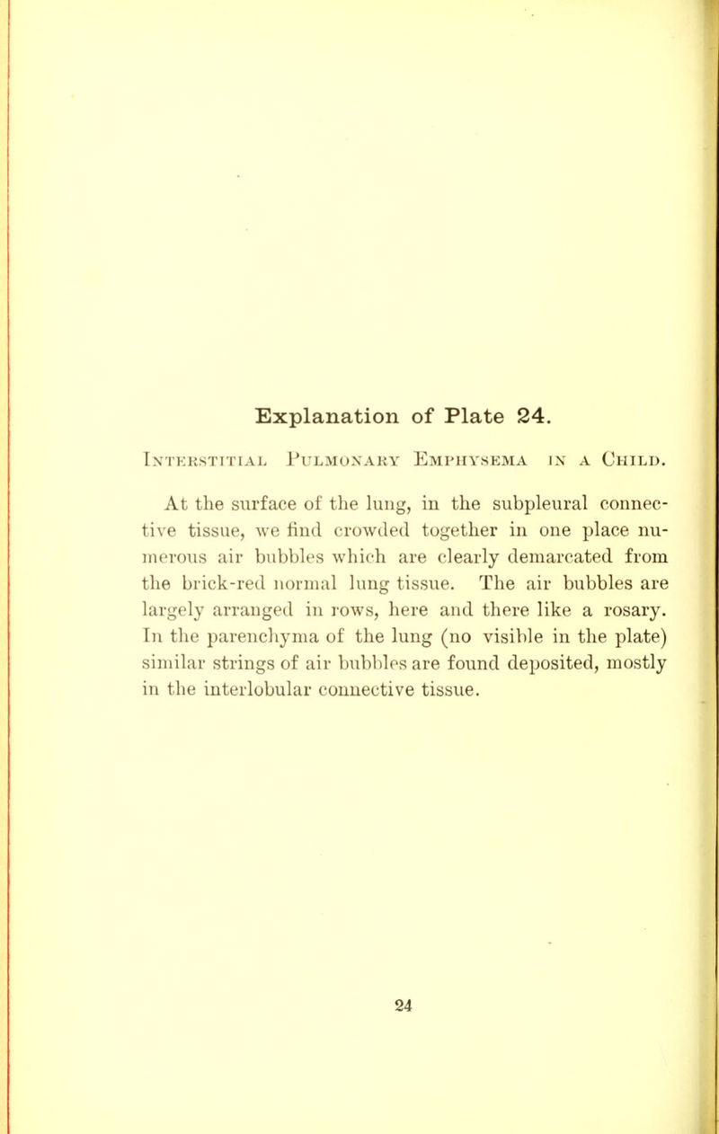 Intkkstttial Pulmonary Emphysema in a Child. At the surface of the lung, in the subpleural connec- tive tissue, we find crowded together in one place nu- merous air bubbles which are clearly demarcated from the brick-red normal lung tissue. The air bubbles are largely arranged in rows, here and there like a rosary. In the parenchyma of the lung (no visible in the plate) similar strings of air bubbles are found deposited, mostly in the interlobular connective tissue. 24
