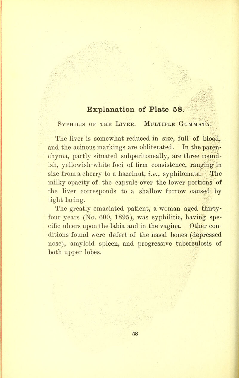 Syphilis of the Liver. Multiple Gummata. The liver is somewhat reduced in size, full of blood, and the acinous markings are obliterated. In the paren- chyma, partly situated subperitoneally, are three round- ish, yellowish-white foci of firm consistence, ranging in size from a cherry to a hazelnut, i.e., syphilomata.- The milky opacity of the capsule over the lower portions of the liver corresponds to a shallow furrow caused by tight lacing. The greatly emaciated patient, a woman aged thirty- four years (No. 600, 1895), was syphilitic, having spe- cific ulcers upon the labia and in the vagina. Other con- ditions found were defect of the nasal bones (depressed nose), amyloid spleen, and progressive tuberculosis of both upper lobes. 58