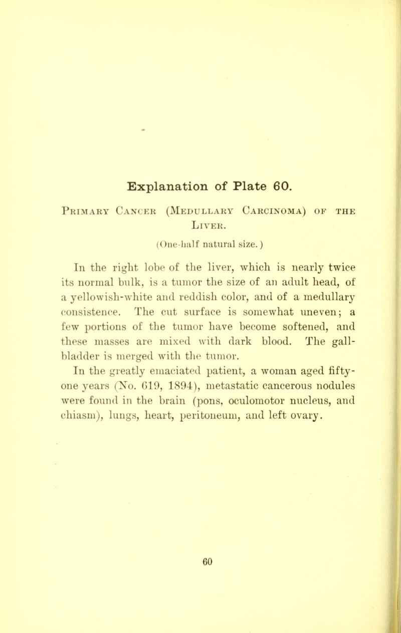 Primary Cancer (Medullary Carcinoma) of the Liver. (One-half natural size.) In the right lobe of the liver, which is nearly twice its normal bulk, is a tumor the size of an adult head, of a yellowish-white and reddish color, and of a medullary consistence. The cut surface is somewhat uneven; a few portions of the tumor have become softened, and these masses are mixed with dark blood. The gall- bladder is merged with the tumor. In the greatly emaciated patient, a woman aged fifty- one years (No. G19, 1894), metastatic cancerous nodules were found in the brain (pons, oculomotor nucleus, and chiasm), lungs, heart, peritoneum, and left ovary. 60