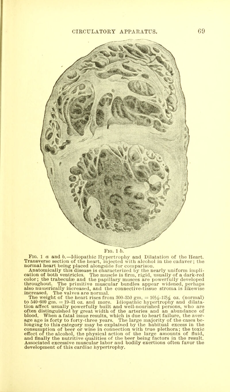 Fig. 1 b. Fig. 1 a and ö.—Idiopathic Hypertiophy and Dilatation of the Heart. Transverse section of the heart, injected with alcohol in the cadaver; the normal heart being placed aloiigsitle for comparison. Anatomically this disease is characterized by the nearly uniform impli- cation of both ventricles. The muscle is firm, rigid, usually of a dark-red color; the trabeculae and the papillary musces are powerfully developed throughout. The primitive muscular bundles appear widened, perhaps also numerically increased, and the connective-tissue stroma is likewise increased. The valves are normal. The weight of the heart rises from 300-350 gm. = lOJ^lS)^ oz, (normal) to 540-G00 gm. = 19-21 oz. and more. Idiopathic hypertrophy and dilata- tion affect usually powerfully built and well-nourished persons, who are often distinguished by great width of the arteries and an abundance of blood. Wiieu a fatal issue results, which is due to heart failure, the aver- age age is forty to forty-three years. The large majority of the cases be- longing to this category may be explained by the habitual excess in the consumption of beer or wine in connection with true plethora; the toxic effect of the alcohol, the physical action of the large amounts of fluid, and finally the nutritive qualities of the beer being factors in the result. Associated excessive muscular labor and bodily exertions often favor the development of this cardiac hypertrophy.