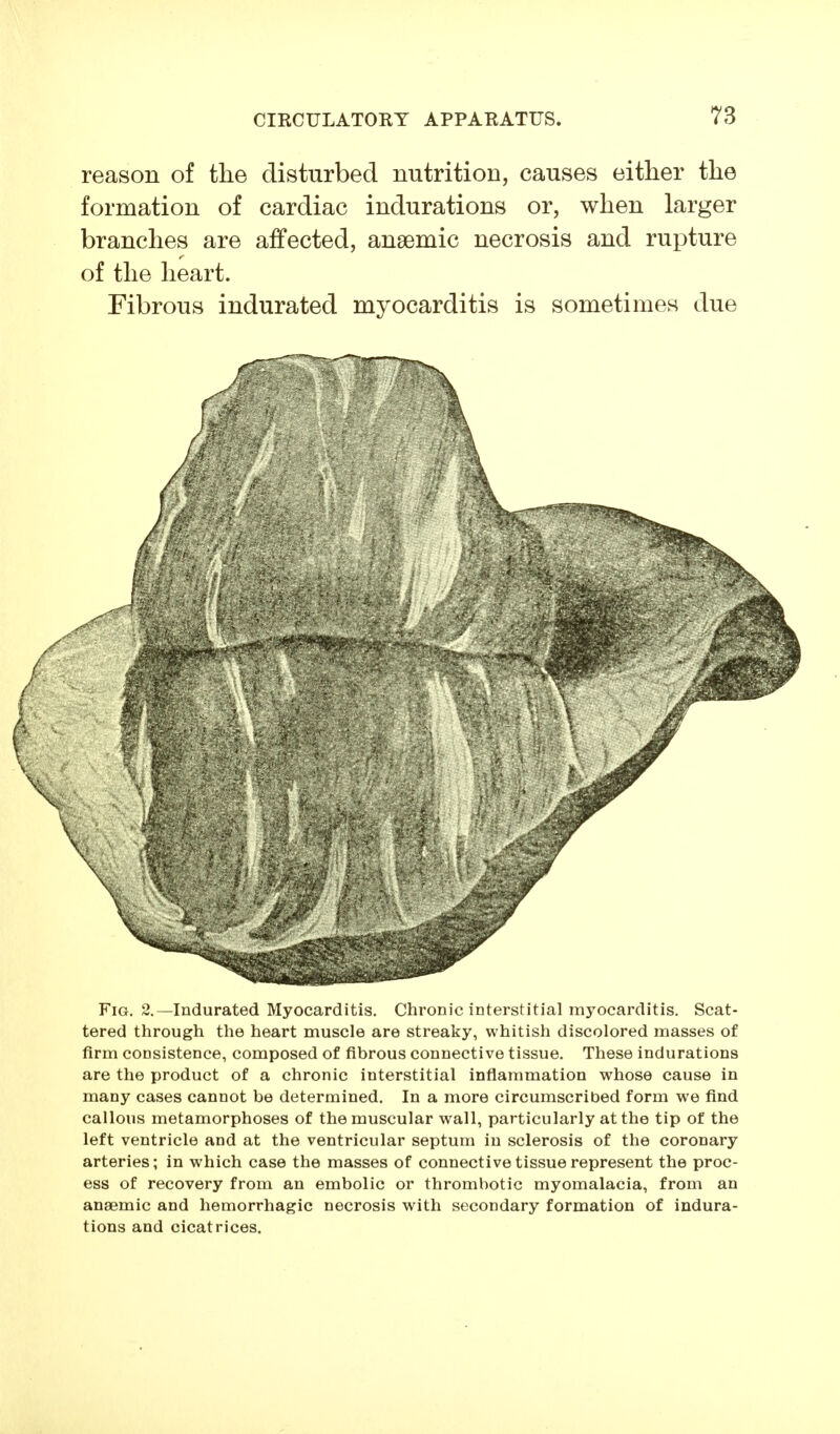 reason of the disturbed nutrition, causes either the formation of cardiac indurations or, when larger branches are affected, ansemic necrosis and rupture of the heart. Fibrous indurated myocarditis is sometimes due Fig. 2.—Indurated Myocarditis. Chronic interstitial myocarditis. Scat- tered through the heart muscle are streaky, whitish discolored masses of firm consistence, composed of fibrous connective tissue. These indurations are the product of a chronic interstitial inflammation whose cause in many cases cannot be determined. In a more circumscribed form we find callous metamorphoses of the muscular wall, particularly at the tip of the left ventricle and at the ventricular septum in sclerosis of the coronary arteries; in which case the masses of connective tissue represent the proc- ess of recovery from an embolic or thrombotic myomalacia, from an anaemic and hemorrhagic necrosis with secondary formation of indura- tions and cicatrices.