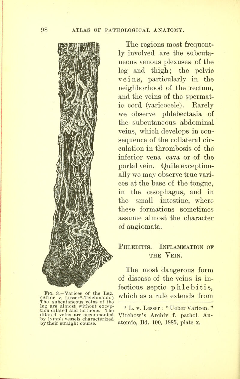 Fig. 3.—Varices of the Leg. (After V. Lesser*-Teichmann.) The subcutaneous veins of the leg are almost without excep- tion dilated and tortuous. The dilated veins are accompanied by lymph vessels characterized by their straight course. The regions most frequent- ly involved are tlie subcuta- neous venous plexuses of the leg and thigh; the pelvic veins, particularly in the neighborhood of the rectum, and the veins of the spermat- ic cord (varicocele). Rarely we observe phlebectasia of the subcutaneous abdominal veins, which develops in con- sequence of the collateral cir- culation in thrombosis of the inferior vena cava or of the portal vein. Quite exception- ally we may observe true vari- ces at the base of the tongue, in the oesophagus, and in the small intestine, where these formations sometimes assume almost the character of angiomata. Phlebitis. Inflammation of THE Vein. The most dangerous form of disease of the veins is in- fectious septic phlebitis, which as a rule extends from * L. V, Lesser : Ueber Varicen. Virchow's Archiv f. pathol. An- atomie, Bd. 100, 1885, plate x.