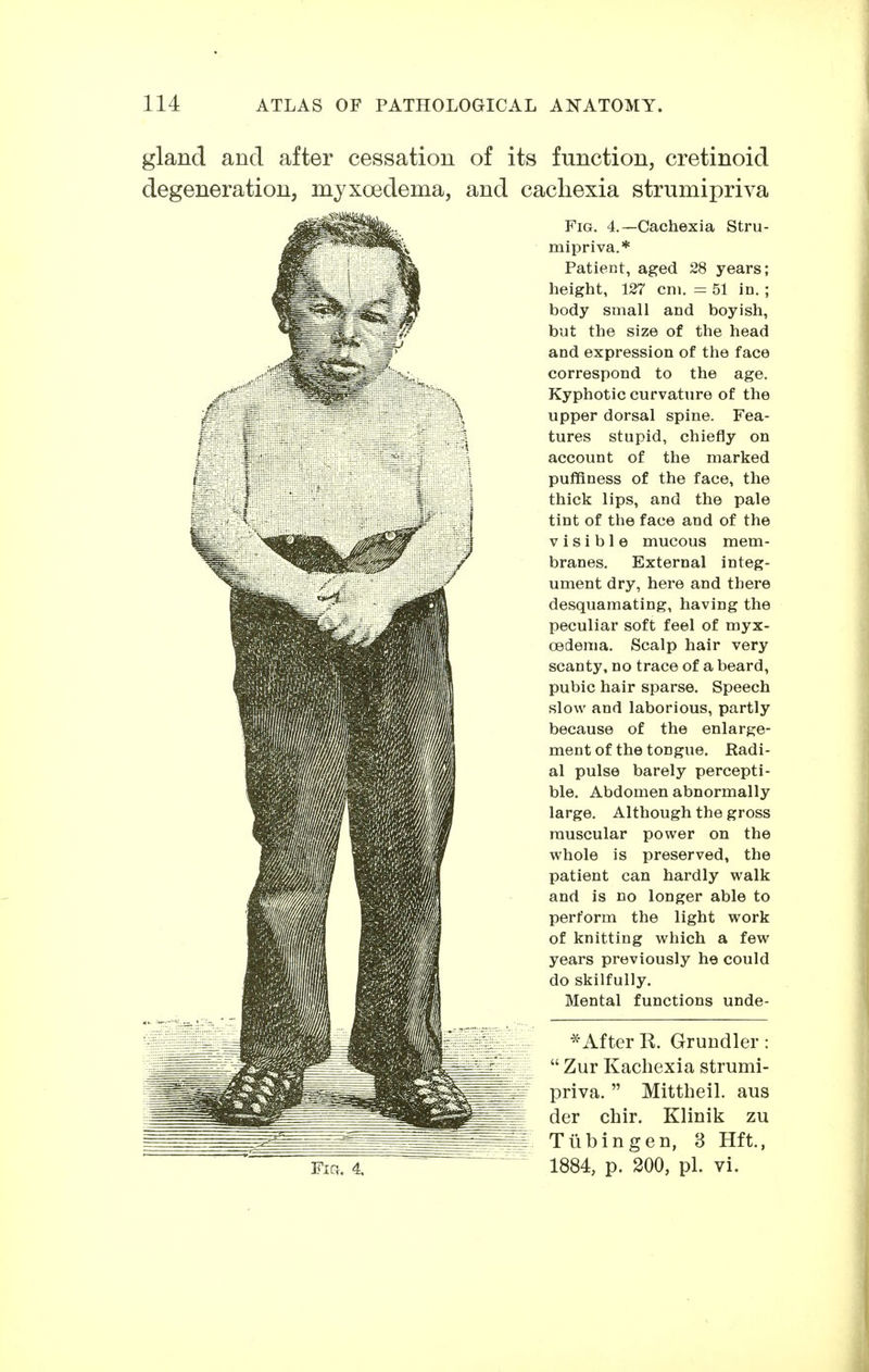 gland and after cessation of its function, cretinoid degeneration, myxoedema, and cachexia strumipriva Fia. 4. Fig. 4.—Cachexia Stru- mipriva.* Patient, aged 28 years; height, 127 cm. = 51 in.; body small and boyish, but the size of the head and expression of the face correspond to the age. Kyphotic curvature of the upper dorsal spine. Fea- tures stupid, chiefly on account of the marked puffiness of the face, the thick lips, and the pale tint of the face and of the visible mucous mem- branes. External integ- ument dry, here and there desquamating, having the peculiar soft feel of myx- oedema. Scalp hair very scanty, no trace of a beard, pubic hair sparse. Speech slow and laborious, partly because of the enlarge- ment of the tongue. Radi- al pulse barely percepti- ble. Abdomen abnormally large. Although the gross muscular power on the whole is preserved, the patient can hardly walk and is no longer able to perform the light work of knitting which a few years previously he could do skilfully. Mental functions unde- *After K. Grundler:  Zur Kachexia strumi- priva.  Mittheil, aus der chir. Klinik zu Tübingen, 3 Hft., 1884, p. 200, pl. vi.