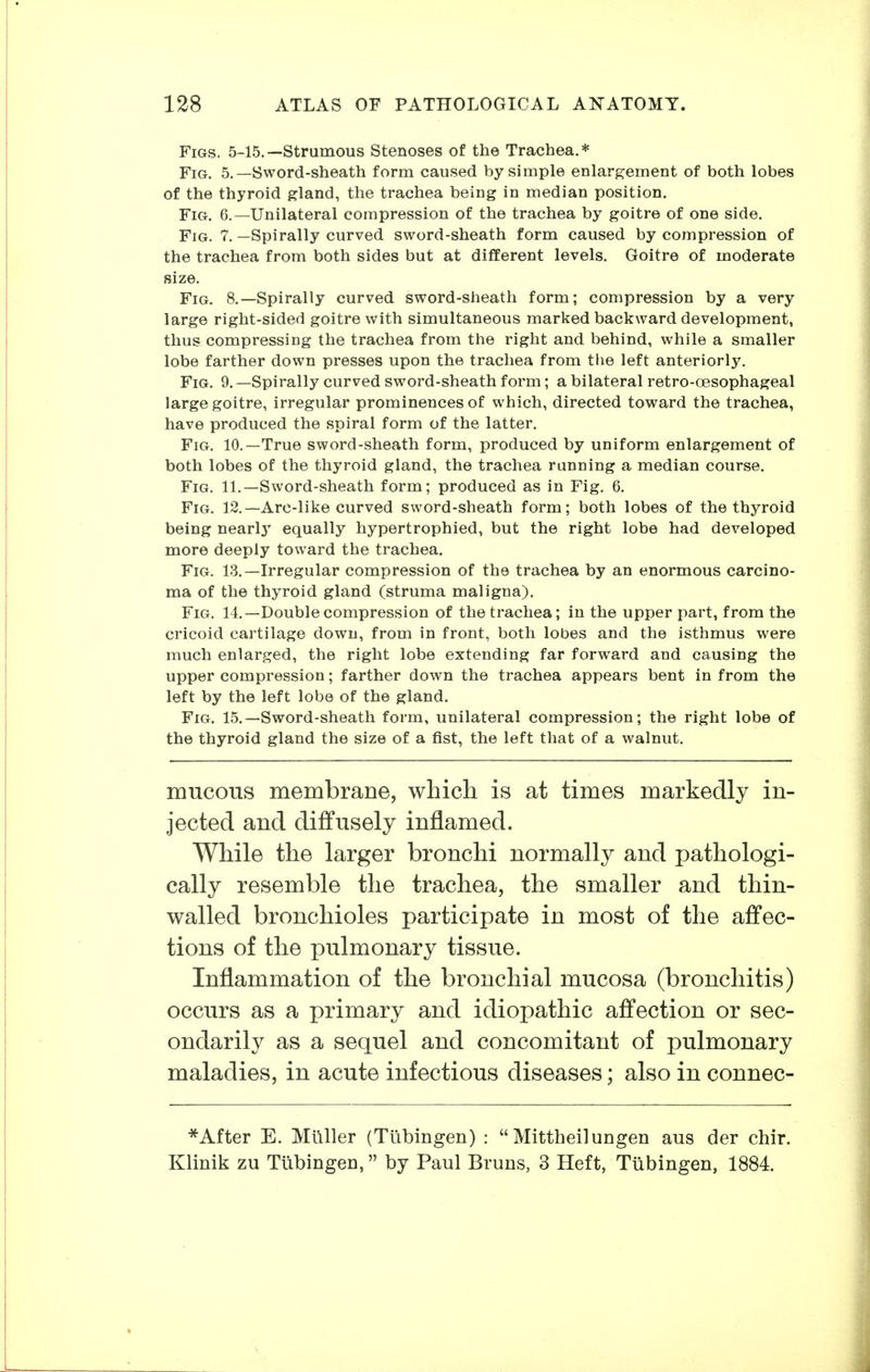 Figs. 5-15.—Strumous Stenoses of the Trachea.* Fig. 5.—Sword-sheath form caused by simple enlargement of both lobes of the thyroid gland, the trachea being in median position, YiG. 6.—Unilateral compression of the trachea by goitre of one side. Fig. 7. —Spirally curved sword-sheath form caused by compression of the trachea from both sides but at different levels. Goitre of moderate size. Fig. 8.—Spirally curved sword-sheath form; compression by a very large right-sided goitre with simultaneous marked backward development, thus compressing the trachea from the right and behind, while a smaller lobe farther down presses upon the trachea from tlie left anteriorly. Fig. 9.—Spirally curved sword-sheath form; a bilateral retro-oesophageal large goitre, irregular prominences of which, directed toward the trachea, have produced the spiral form of the latter. Fig. 10.—True sword-sheath form, produced by uniform enlargement of both lobes of the thyroid gland, the trachea running a median course. Fig. 11.—Sword-sheath form; produced as in Fig. 6. Fig. 12.—Arc-like curved sword-sheath form; both lobes of the thyroid being nearlj' equally hypertrophied, but the right lobe had developed more deeply toward the trachea. Fig. 13.—Irregular compression of the trachea by an enormous carcino- ma of the thyroid gland (struma maligna). Fig. 14.—Double compression of the trachea; in the upper part, from the cricoid cartilage down, from in front, both lobes and the isthmus were much enlarged, the right lobe extending far forward and causing the upper compression; farther down the trachea appears bent in from the left by the left lobe of the gland. Fig. 15.—Sword-sheath form, unilateral compression; the right lobe of the thyroid gland the size of a fist, the left that of a walnut. mucous membrane, which is at times markedly in- jected and diffusely inflamed. While the larger bronchi normally and pathologi- cally resemble the trachea, the smaller and thin- walled bronchioles participate in most of the affec- tions of the pulmonary tissue. Inflammation of the bronchial mucosa (bronchitis) occurs as a primary and idiopathic affection or sec- ondarily as a sequel and concomitant of pulmonary maladies, in acute infectious diseases; also in connec- *After E. Müller (Tiibingen) : Mittheilungen aus der chir. Klinik zu Tübingen, by Paul Bruns, 3 Heft, Tübingen, 1884.