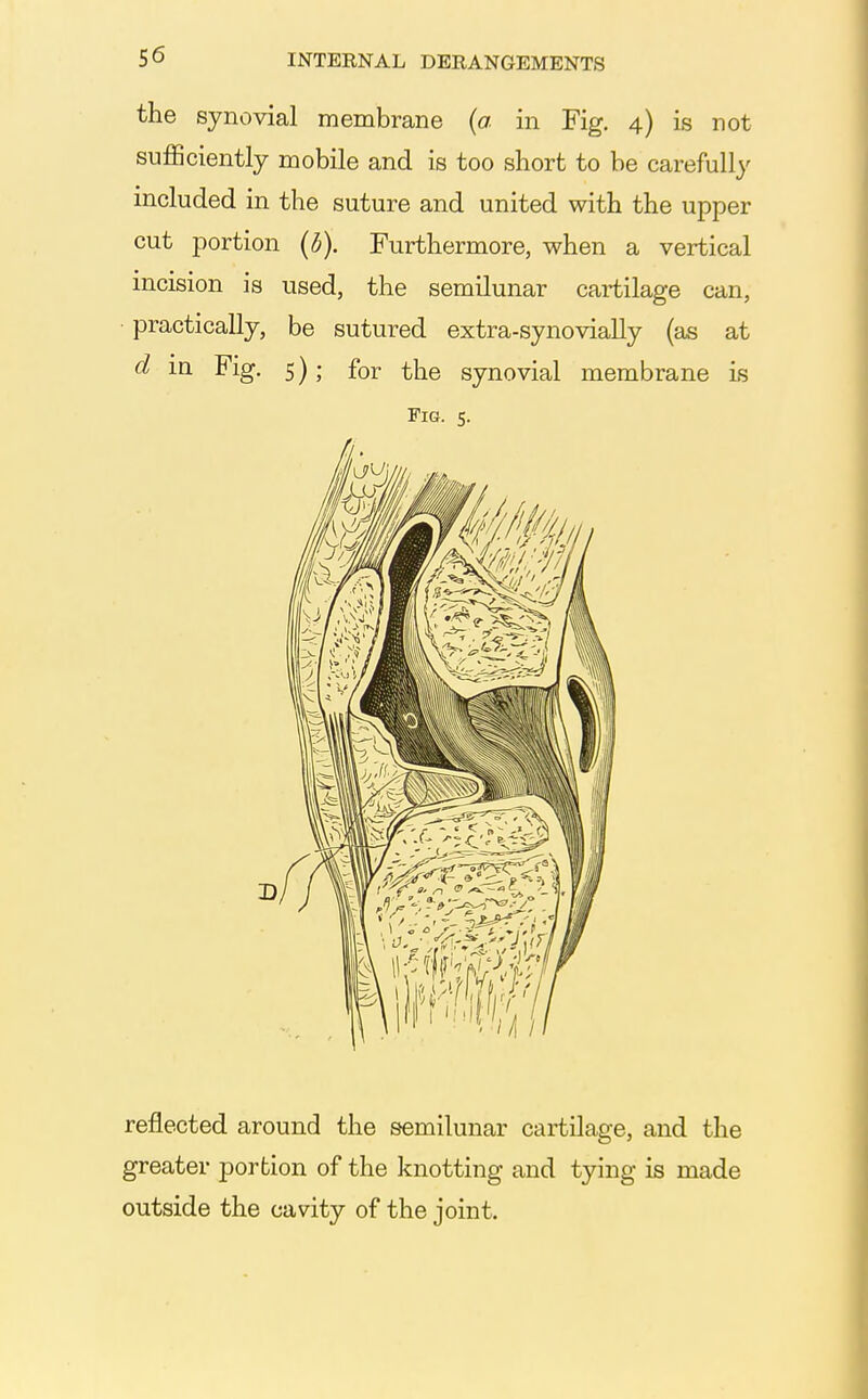 the synovial membrane {a in Fig. 4) is not sufficiently mobile and is too short to be carefully included in the suture and united with the upper cut portion (b). Furthermore, when a vertical incision is used, the semilunar cartilage can, practically, be sutured extra-synovially (as at d in Fig. 5); for the synovial membrane Ls Fig. 5. reflected around the semilunar cartilage, and the greater portion of the knotting and tying is made outside the cavity of the joint.