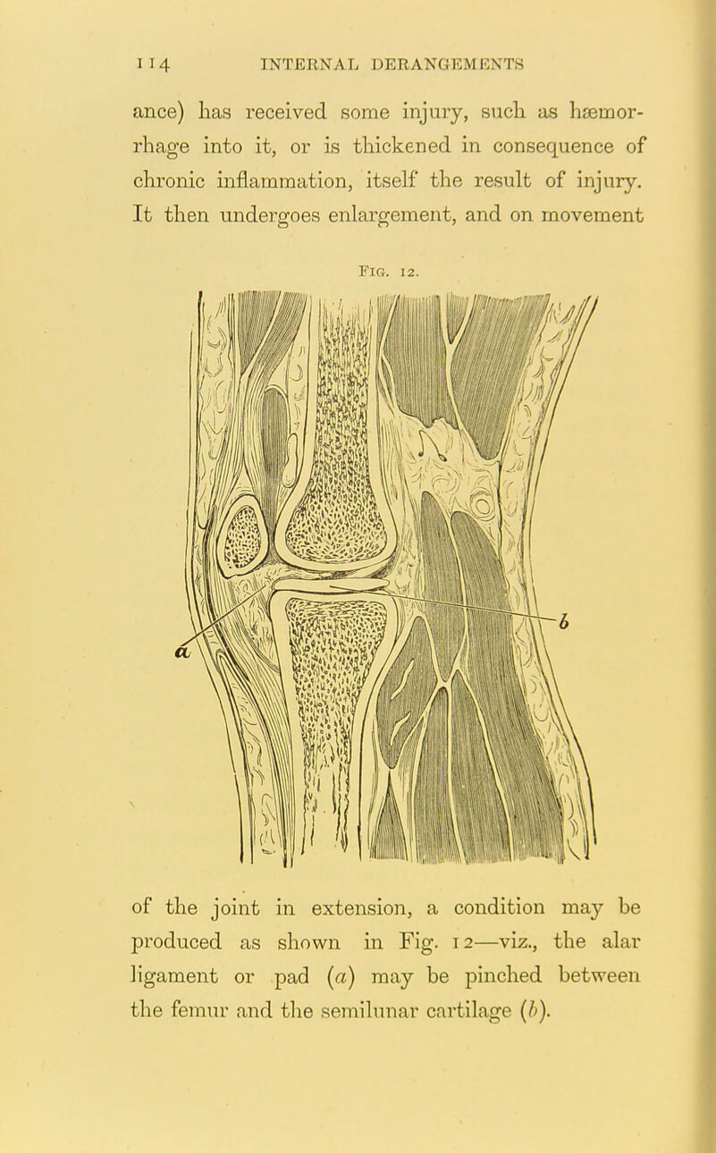 ance) has received some injury, such as haemor- rhage into it, or is thickened in consequence of chronic inflammation, itself the result of injury. It then undergoes enlargement, and on movement Fig. 12. of the joint in extension, a condition may be produced as shown in Fig. 12—viz., the alar ligament or pad (a) may be pinched between the femur and the semilunar cartilage (b).