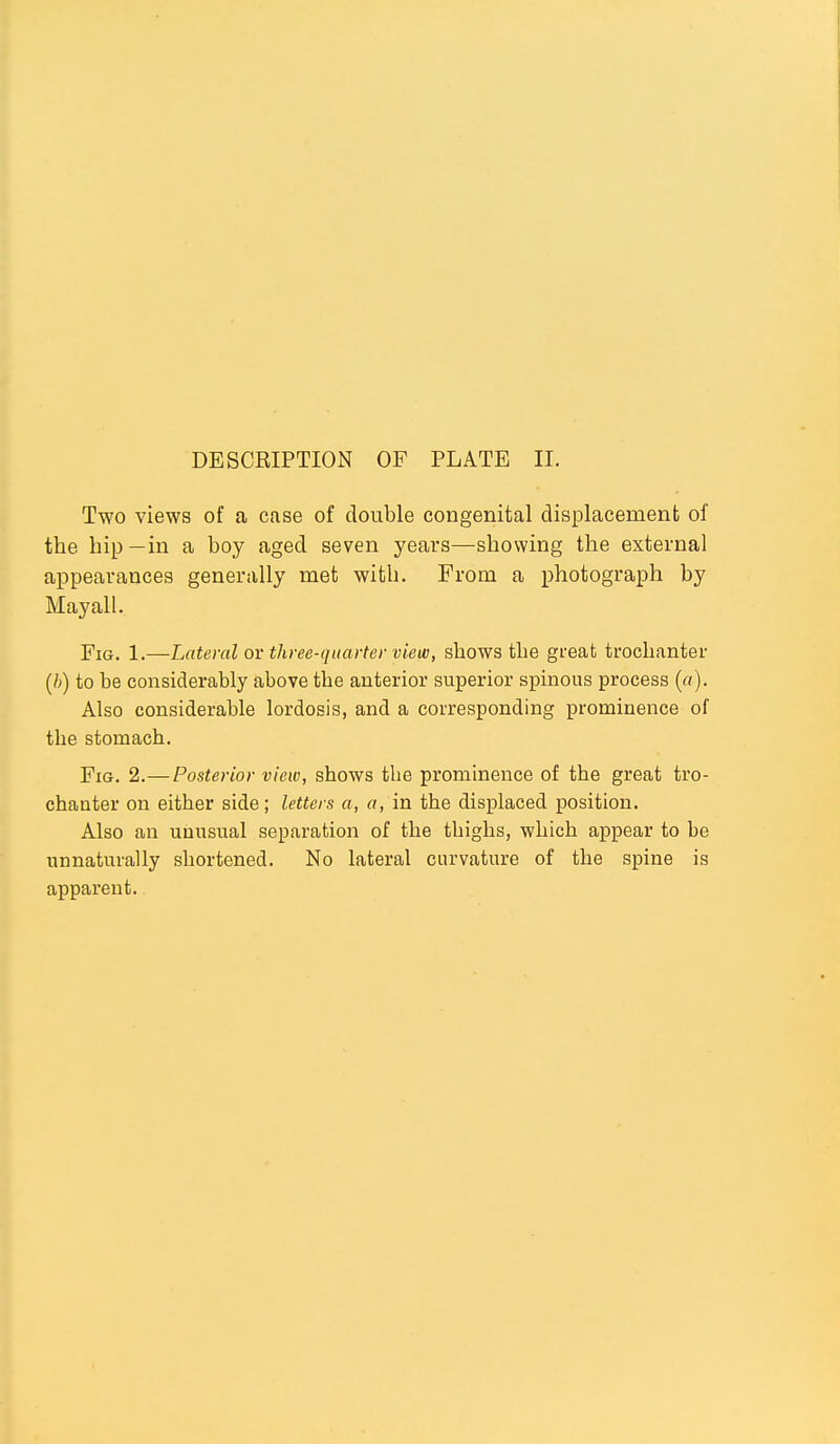 Two views of a case of double congenital displacement of the hip—in a boy aged seven years—showing the external appearances generally met with. From a photograph by Mayall. Fig. 1.—Lateral or three-quarter view, shows the great trochanter (b) to be considerably above the anterior superior spinous process («). Also considerable lordosis, and a corresponding prominence of the stomach. Fig. 2.—Posterior view, shows the prominence of the great tro- chanter on either side; letters a, a, in the displaced position. Also an unusual separation of the thighs, which appear to be unnaturally shortened. No lateral curvature of the spine is apparent.