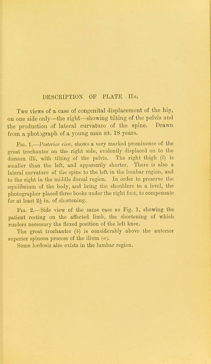 Two views of a case of congenital displacement of the hip, on one side only—the right—showing tilting of the pelvis and the production of lateral curvature of the spine. Drawn from a photograph of a young man set. 18 years. Fig. 1.—Posterior view, shows a very marked prominence of the great trochanter on the right side, evidently displaced on to the dorsum illi, with tilting of the pelvis. The right thigh {I) is smaller than the left, and apparently shorter. There is also a lateral curvature of the spine to the left in the lumbar region, and to the right in the middle dorsal region. In order to preserve the equilibrium of the body, and bring the shoulders to a level, the photographer placed three books under the right foot, to compensate for at least 2^ in. of shortening. Fig. 2.—Side view of the same case as Fig. 1, showing the patient resting on the affected limb, the shortening of which renders necessary the flexed position of the left knee. The great trochanter (b) is considerably above the anterior superior spinous process of the ilium («). Some lordosis also exists in the lumbar region.