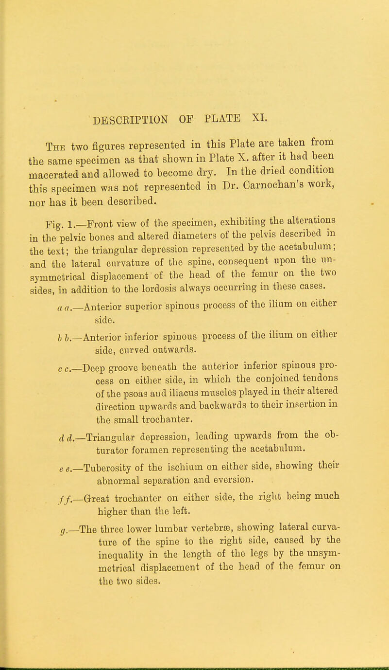 The two figures represented in this Plate are taken from the same specimen as that shown in Plate X. after it had been macerated and allowed to become dry. In the dried condition this specimen was not represented in Dr. Carnochan's work, nor has it been described. Yio. 1.—Front view of the specimen, exhibiting the alterations in the°pelvic bones and altered diameters of the pelvis described in the text; the triangular depression represented by the acetabulum; and the lateral curvature of the spine, consequent upon the un- symmetrical displacement of the head of the femur on the two sides, in addition to the lordosis always occurring in these cases, rtrt—Anterior superior spinous process of the ihum on either side. b i.—Anterior inferior spinous process of the ihum on either side, curved outwards. c c—Deep groove beneath the anterior inferior spinous pro- cess on either side, in which the conjoined tendons of the psoas and iliacus muscles played in their altered direction upwards and backwards to their insertion in the small trochanter. ci ii.—Triangular depression, leading upwards from the ob- turator foramen representing the acetabulum. e e.—Tuberosity of the ischium on either side, showing their abnormal separation and eversion. f/.—Great trochanter on either side, the right being much higher than the left. </.—The three lower lumbar vertebrte, showing lateral curva- ture of the spine to the right side, caused by the inequality in the length of the legs by the unsym- metrical displacement of the head of the femur on the two sides.