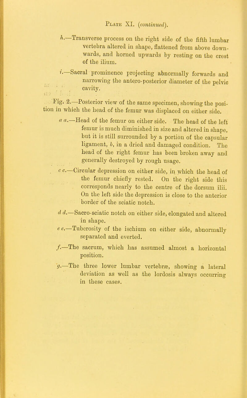 Platk XI. (continued). A.—Transverse process on the right side of the fifth lumbar vertebra altered in shape, flattened from above down- wards, and horned upwards by resting on the crest of the ilium. ?.—Sacral prominence projecting abnormally forwards and narrowing the antero-posterior diameter of the pelvic cavity. Fig. 2.—Posterior view of the same specimen, showing the posi- tion in which the head of the femur was displaced on either side. a rt.—Head of the femur on either side. The head of the left femur is much diminished in size and altered in shape, but it is still surrounded by a portion of the capsular ligament, b, in a dried and damaged condition. The head of the right femur has been broken away and generally destroyed by rough usage. . c c.—Circular depression on either side, in which the head of the femur chiefly rested. On the right side this corresponds nearly to the centre of the dorsum ilii. On the left side the depression is close to the anterior border of the sciatic notch. d d.—Sacro-sciatic notch on either side, elongated and altered in shape. ee.—Tuberosity of the ischium on either side, abnormally separated and everted. /•—The sacrum, which has assumed almost a horizontal position. fl-—The three lower lumbar vertebrae, showing a lateral deviation as well as the lordosis always occurring in these cases.