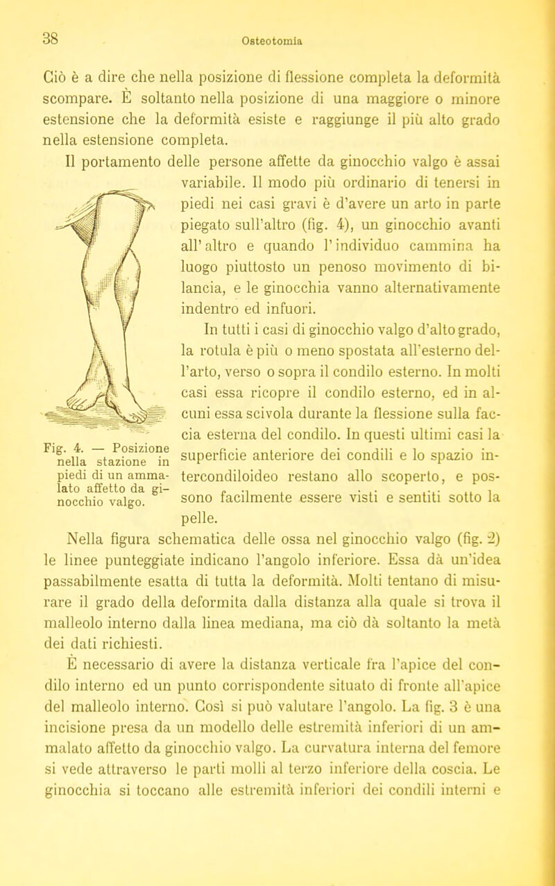 Ciò è a dire che nella posizione di flessione completa la deformità scompare. E soltanto nella posizione di una maggiore o minore estensione che la deformità esiste e raggiunge il più alto grado nella estensione completa. Il portamento delle persone affette da ginocchio valgo è assai variabile. Il modo più ordinario di tenersi in piedi nei casi gravi è d'avere un arto in parte piegato sull'altro (fig. 4), un ginocchio avanti all'altro e quando l'individuo cammina ha luogo piuttosto un penoso movimento di bi- lancia, e le ginocchia vanno alternativamente indentro ed infuori. In tutti i casi di ginocchio valgo d'alto grado, la rotula è più o meno spostata all'esterno del- l'arto, verso o sopra il condilo esterno. In molti casi essa ricopre il condilo esterno, ed in al- cuni essa scivola durante la flessione sulla fac- cia esterna del condilo. In questi ultimi casi la superficie anteriore dei condili e lo spazio in- tercondiloideo restano allo scoperto, e pos- sono facilmente essere visti e sentiti sotto la pelle. Nella figura schematica delle ossa nel ginocchio valgo (fig. *2) le linee punteggiate indicano l'angolo inferiore. Essa dà un'idea passabilmente esatta di tutta la deformità. Molti tentano di misu- rare il grado della deformità dalla distanza alla quale si trova il malleolo interno dalla linea mediana, ma ciò dà soltanto la metà dei dati richiesti. E necessario di avere la distanza verticale fra l'apice del con- dilo interno ed un punto corrispondente situato di fronte all'apice del malleolo interno. Così si può valutare l'angolo. La fig. 3 ò una incisione presa da un modello delle estremità inferiori di un am- malato affetto da ginocchio valgo. La curvatura interna del femore si vede attraverso le parti molli al terzo inferiore della coscia. Le ginocchia si toccano alle estremità inferiori dei condili interni e Fig. 4. — Posizione nella stazione in piedi di un amma- lato affetto da gi- nocchio valgo.