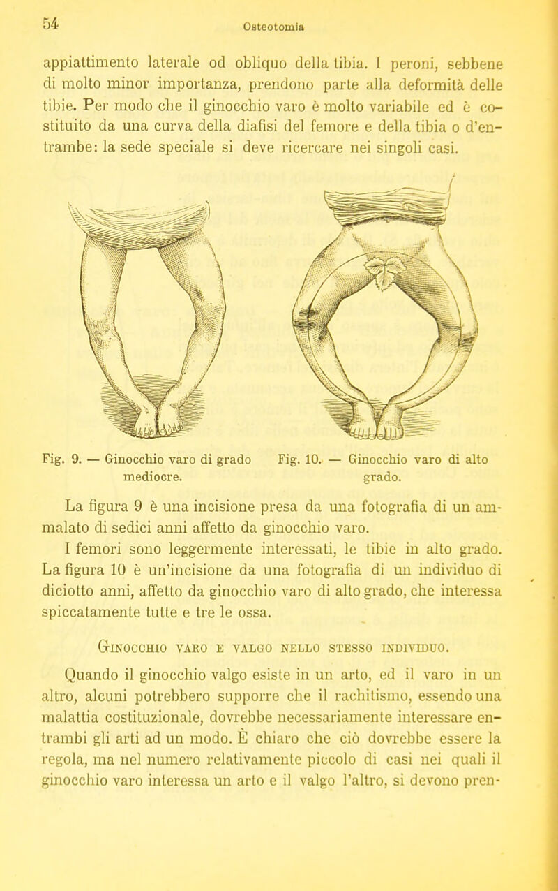 appiattimento laterale od obliquo della tibia. 1 peroni, sebbene di molto minor importanza, prendono parte alla deformità delle tibie. Per modo che il ginocchio varo è molto variabile ed è co- stituito da una curva della diansi del femore e della tibia o d'en- trambe: la sede speciale si deve ricercare nei singoli casi. Fig. 9. — Ginocchio varo di grado Fig. 10. — Ginocchio varo di alto mediocre. grado. La figura 9 è una incisione presa da una fotografia di un am- malato di sedici anni affetto da ginocchio varo. I femori sono leggermente interessati, le tibie in alto grado. La figura 10 è un'incisione da una fotografia di un individuo di diciotto anni, affetto da ginocchio varo di alto grado, che interessa spiccatamente tutte e tre le ossa. Gr INOCCHIO VARO E VALGO NELLO STESSO INDIVIDUO. Quando il ginocchio valgo esiste in un arto, ed il varo in un altro, alcuni potrebbero supporre che il rachitismo, essendo una malattia costituzionale, dovrebbe necessariamente interessare en- trambi gli arti ad un modo. E chiaro che ciò dovrebbe essere la regola, ma nel numero relativamente piccolo di casi nei quali il ginocchio varo interessa un arto e il valgo l'altro, si devono pren-