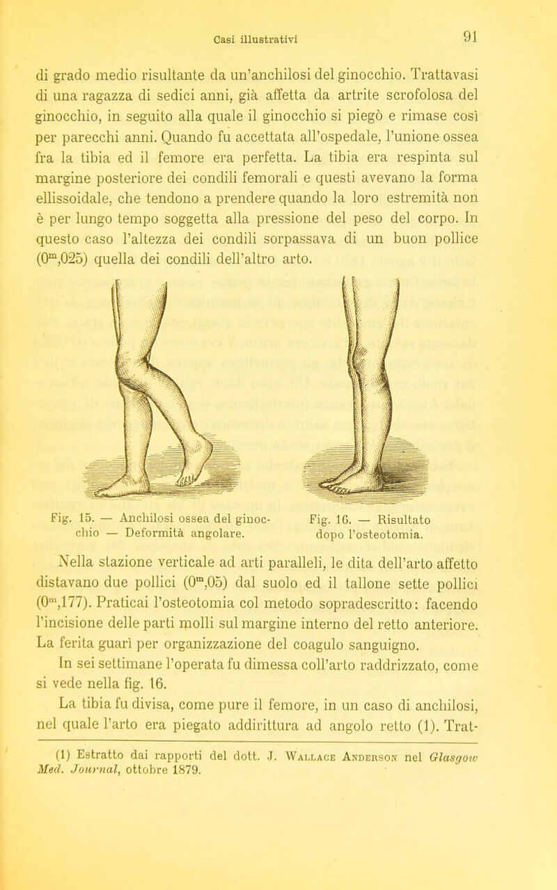 Oasi illustrativi 9] di grado medio risultante da un'anchilosi del ginocchio. Trattavasi di una ragazza di sedici anni, già affetta da artrite scrofolosa del ginocchio, in seguito alla quale il ginocchio si piegò e rimase così per parecchi anni. Quando fu accettata all'ospedale, l'unione ossea fra la tibia ed il femore era perfetta. La tibia era respinta sul margine posteriore dei condili femorali e questi avevano la forma ellissoidale, che tendono a prendere quando la loro estremità non è per lungo tempo soggetta alla pressione del peso del corpo. In questo caso l'altezza dei condili sorpassava di un buon pollice (O^.OSS) quella dei condili dell'altro arto. Fig. 15. — Anchilosi ossea del giuoc- Fig. 1G. — Risultato chio — Deformità angolare. dopo l'osteotomia. Nella stazione verticale ad arti paralleli, le dita dell'arto affetto distavano due pollici (0m,05) dal suolo ed il tallone sette pollici (0m,177). Praticai l'osteotomia col metodo sopradescritto: facendo l'incisione delle parti molli sul margine interno del retto anteriore. La ferita guarì per organizzazione del coagulo sanguigno. In sei settimane l'operata fu dimessa coll'arto raddrizzato, come si vede nella fig. 16. La tibia fu divisa, come pure il femore, in un caso di anchilosi, nel quale l'arto era piegato addirittura ad angolo retto (1). Trat- ti) Estratto dai rapporti del dott. J. Wallace Anderson nel Glasgow