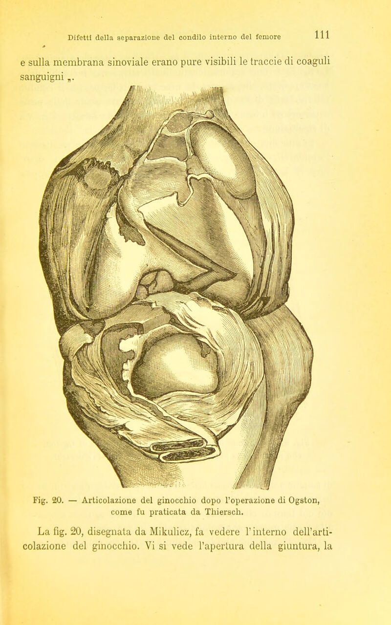 e sulla membrana sinoviale erano pure visibili le traccie di coaguli sanguigni „. Fig. 20. — Articolazione del ginocchio dopo l'operazione di Ogston, come fu praticata da Thiersch. La fig. 20, disegnata da Mikulicz, fa vedere l'interno dell'arti- colazione del ginocchio. Vi si vede l'apertura della giuntura, la