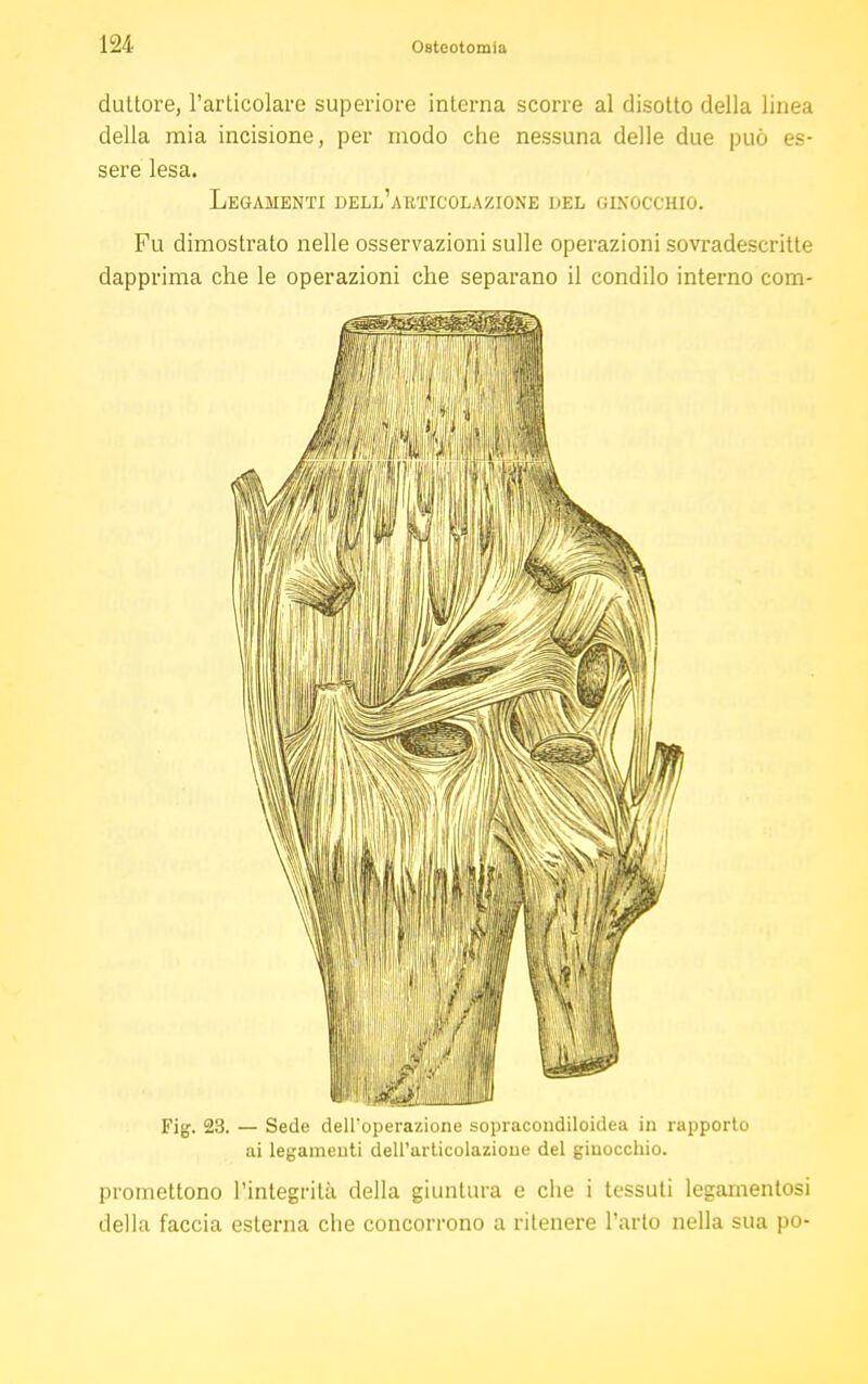 duttore, l'articolare superiore interna scorre al disotto della linea della mia incisione, per modo che nessuna delle due può es- sere lesa. Legamenti dell'articolazione del ginocchio. Fu dimostrato nelle osservazioni sulle operazioni sovradescritte dapprima che le operazioni che separano il condilo interno com- Fig. 23. — Sede dell'operazione sopracondiloidea in rapporto ai legamenti dell'articolazione del ginocchio. promettono l'integrità della giuntura e che i tessuti legarnentosi della faccia esterna che concorrono a ritenere l'arto nella sua po-