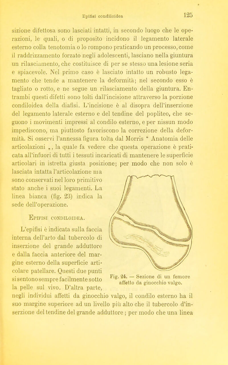 sizione difettosa sono lasciali intatti, in secondo luogo che le ope- razioni, le quali, o di proposito incidono il legamento laterale esterno colla tenotomia o lo rompono praticando un processo, come il raddrizzamento forzato negli adolescenti, lasciano nella giuntura un rilasciamento, che costituisce di per se stesso una lesione seria e spiacevole. Nel primo caso è lasciato intatto un robusto lega- mento che tende a mantenere la deformità; nel secondo esso è tagliato o rotto, e ne segue un rilasciamento della giuntura. En- trambi questi difetti sono tolti dall'incisione attraverso la porzione condiloidea della diatisi. L'incisione è al disopra dell'inserzione del legamento laterale esterno e del tendine del popliteo, che se- guono i movimenti impressi al condilo esterno, e per nissun modo impediscono, ma piuttosto favoriscono la correzione della defor- mità. Si osservi l'annessa figura tolta dal Morris  Anatomia delle articolazioni „, la quale fa vedere che questa operazione è prati- cata all'infuori di tutti i tessuti incaricati di mantenere le superficie articolari in istretta giusta posizione; per modo che non solo è lasciata intatta l'articolazione ma sono conservati nel loro primitivo stato anche i suoi legamenti. La linea bianca (fig. 23) indica la sede dell'operazione. Epifisi condiloidea. L'epifisi è indicata sulla faccia interna dell'arto dal tubercolo di inserzione del grande adduttore e dalla faccia anteriore del mar- gine esterno della superficie arti- colare patellare. Questi due punti si sentono sempre facilmente sotto la pelle sul vivo. D'altra parte, negli individui affetti da ginocchio valgo, il condilo esterno ha il suo margine superiore ad un livello più alto che il tubercolo d'in- serzione del tendine del grande adduttore ; per modo che una linea