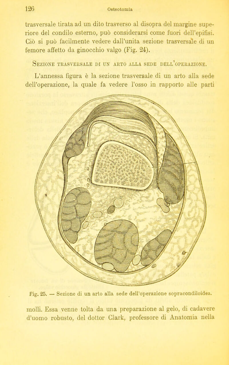 trasversale tirata ad un dito trasverso al disopra del margine supe- riore del condilo esterno, può considerarsi come fuori dell'epifisi. Ciò si può facilmente vedere dall'unita sezione trasversale di un femore affetto da ginocchio valgo (Fig. 24). Sezione trasversale di un arto alla sede dell'operazione. L'annessa figura è la sezione trasversale di un arto alla sede dell'operazione, la quale fa vedere l'osso in rapporto alle parti Fig. 25. — Sezione di un arto alla sede dell'operazione sopracondiloidea. molli. Essa venne tolta da una preparazione al gelo, di cadavere d'uomo robusto, del dottor Clark, professore di Anatomia nella