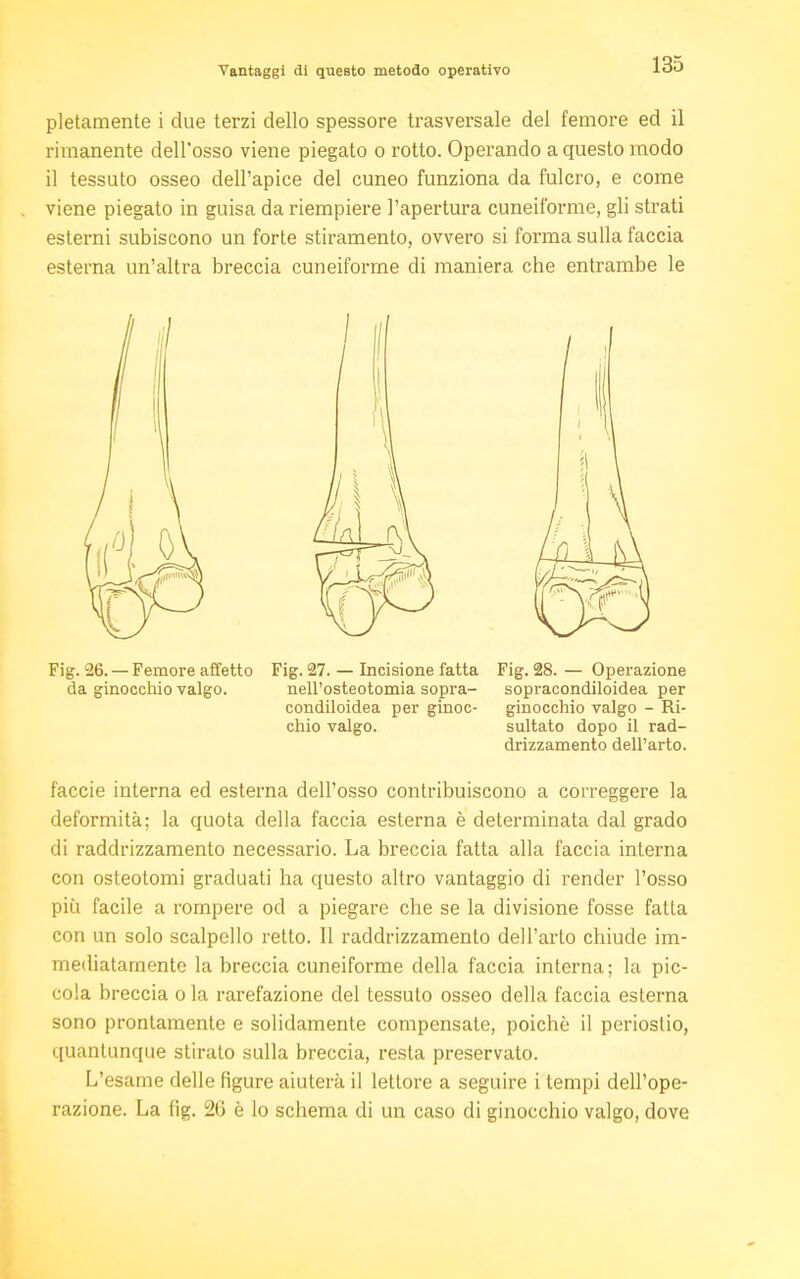 Vantaggi di questo metodo operativo pletamente i due terzi dello spessore trasversale del femore ed il rimanente dell'osso viene piegato o rotto. Operando a questo modo il tessuto osseo dell'apice del cuneo funziona da fulcro, e come viene piegato in guisa da riempiere l'apertura cuneiforme, gli strati esterni subiscono un forte stiramento, ovvero si forma sulla faccia esterna un'altra breccia cuneiforme di maniera che entrambe le Fig. 26. — Femore affetto Fig. 27. — Incisione fatta Fig. 28. — Operazione da ginocchio valgo. nell'osteotomia sopra- sopracondiloidea per condiloidea per ginoc- ginocchio valgo - Ri- chio valgo. sultato dopo il rad- drizzamento dell'arto. faccie interna ed esterna dell'osso contribuiscono a correggere la deformità; la quota della faccia esterna è determinata dal grado di raddrizzamento necessario. La breccia fatta alla faccia interna con osteotomi graduati ha questo altro vantaggio di render l'osso più facile a rompere od a piegare che se la divisione fosse fatta con un solo scalpello retto. Il raddrizzamento dell'arto chiude im- mediatamente la breccia cuneiforme della faccia interna; la pic- cola breccia ola rarefazione del tessuto osseo della faccia esterna sono prontamente e solidamente compensate, poiché il periostio, quantunque stirato sulla breccia, resta preservato. L'esame delle figure aiuterà il lettore a seguire i tempi dell'ope- razione. La fig. 26 è lo schema di un caso di ginocchio valgo, dove